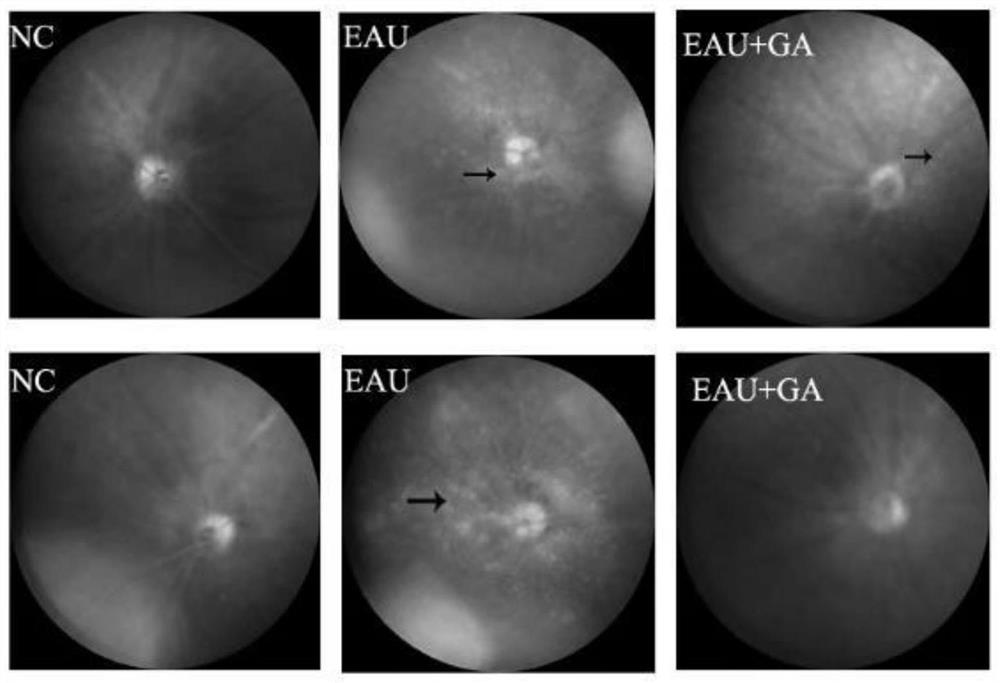 Application of glycyrrhizic acid or glycyrrhizic acid derivative in preparation of medicine for treating retinitis