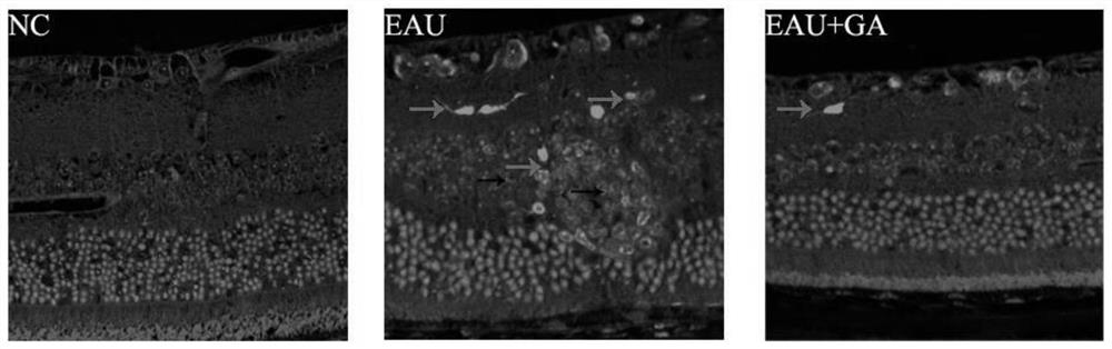 Application of glycyrrhizic acid or glycyrrhizic acid derivative in preparation of medicine for treating retinitis