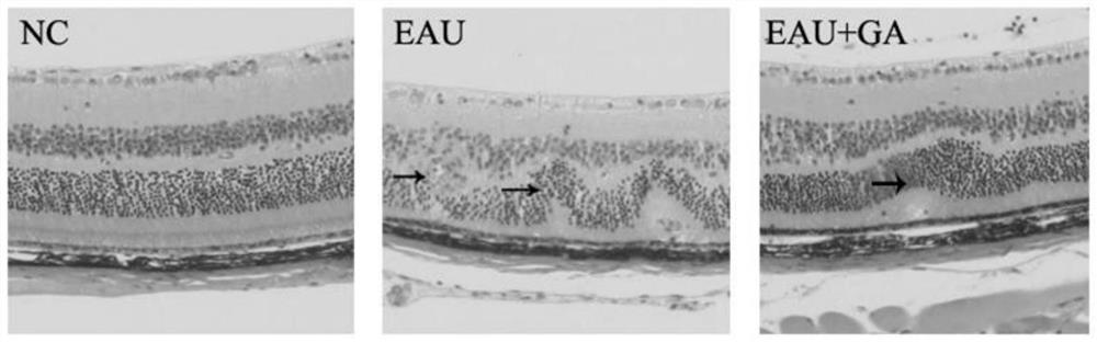 Application of glycyrrhizic acid or glycyrrhizic acid derivative in preparation of medicine for treating retinitis