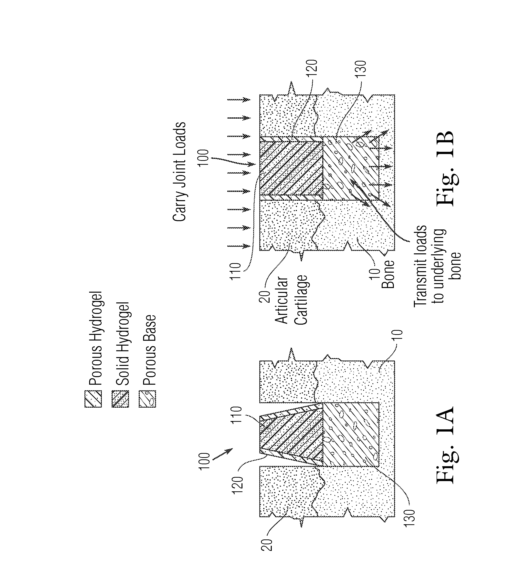 Multi-component non-biodegradable implant, a method of making and a method of implantation