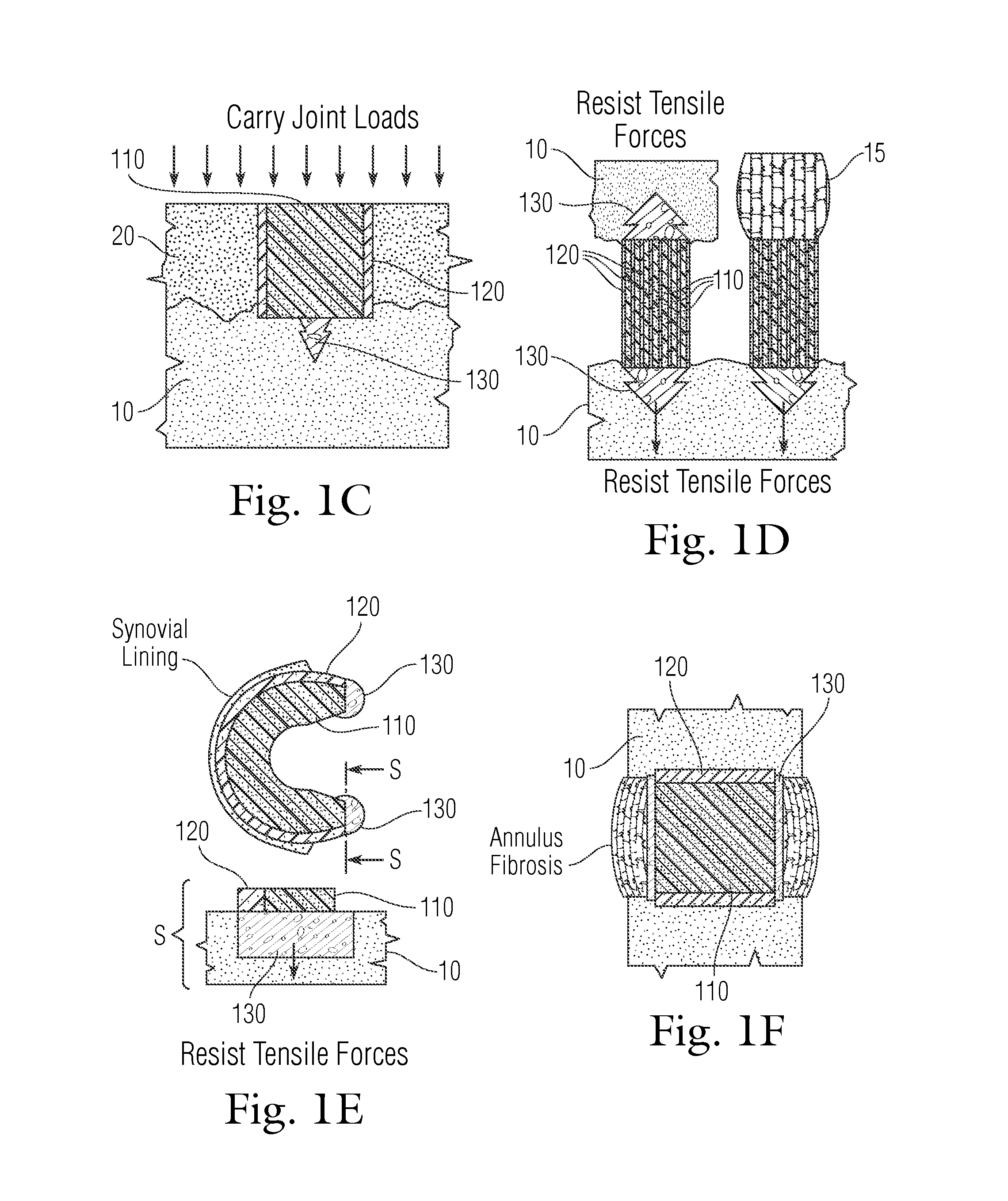 Multi-component non-biodegradable implant, a method of making and a method of implantation