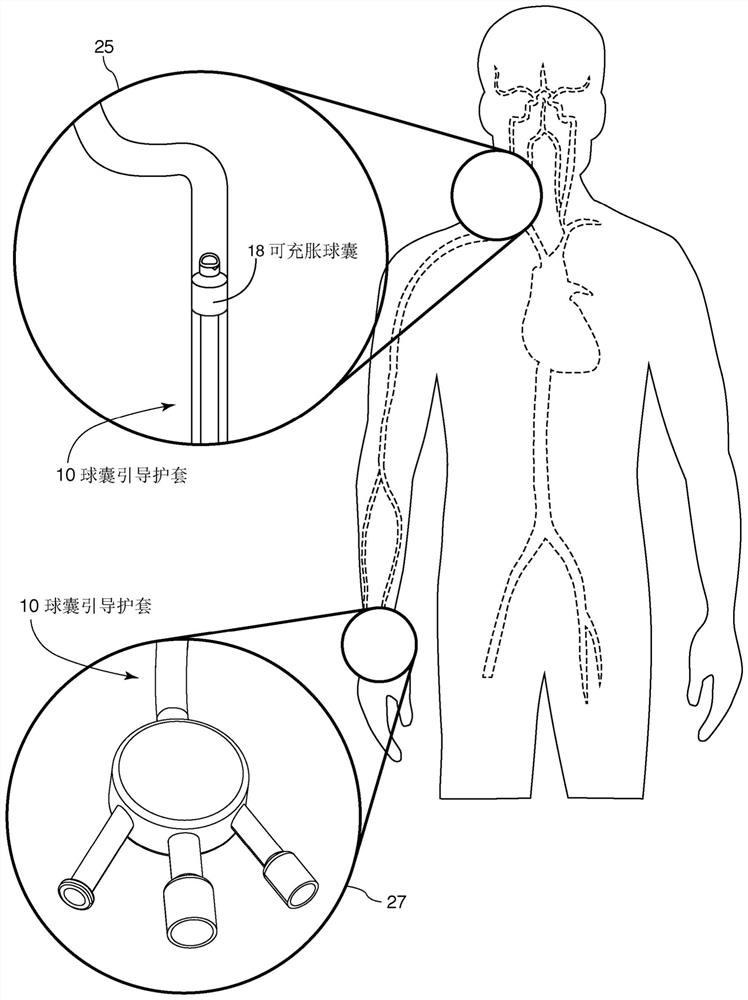 Internal carotid artery thrombectomy devices and methods