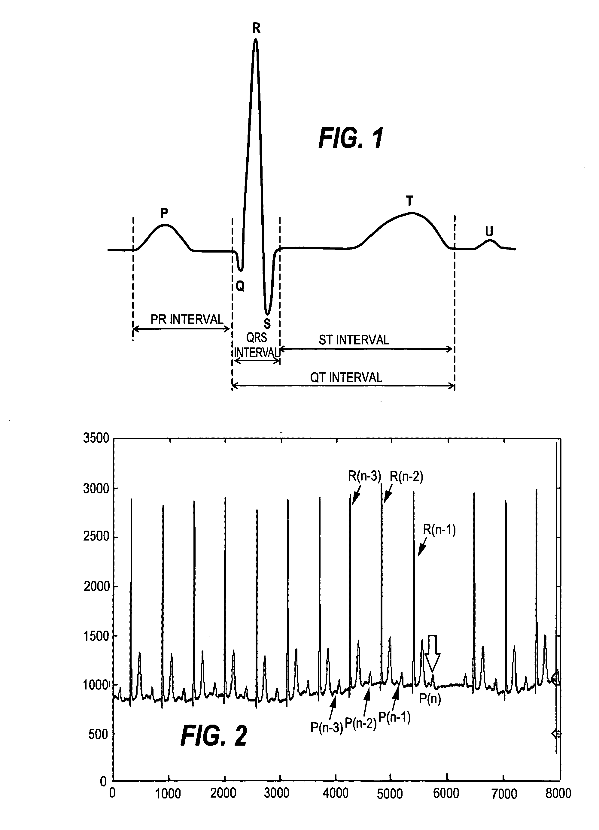 Monitoring of atrial activation