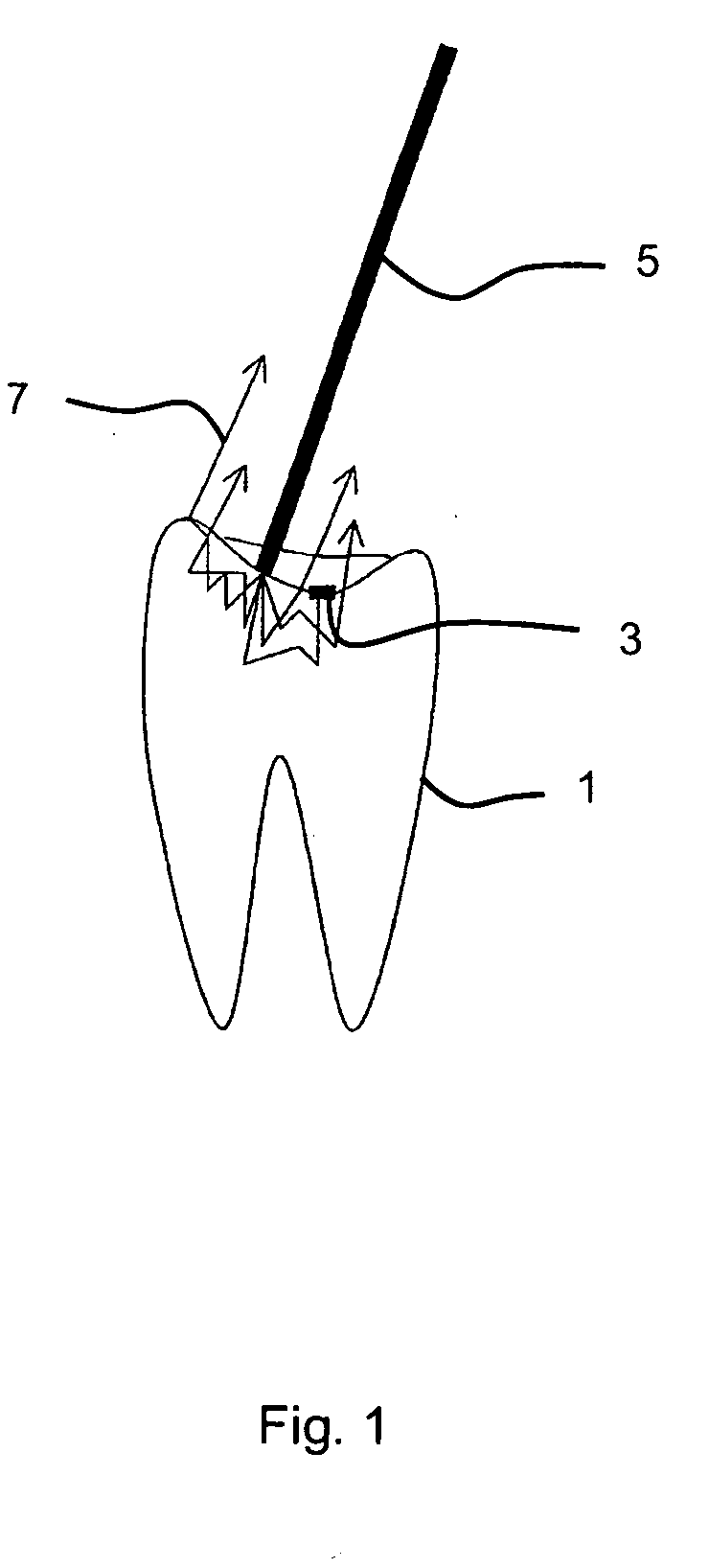 Method and apparatus for identifying tooth-coloured tooth filling residues