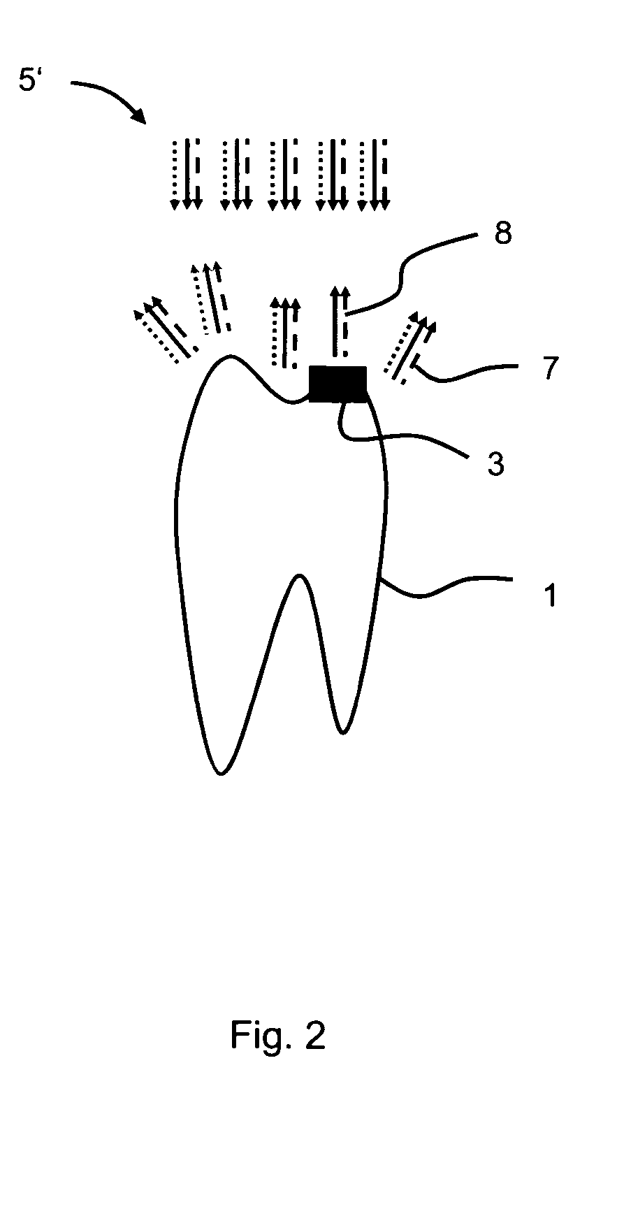 Method and apparatus for identifying tooth-coloured tooth filling residues