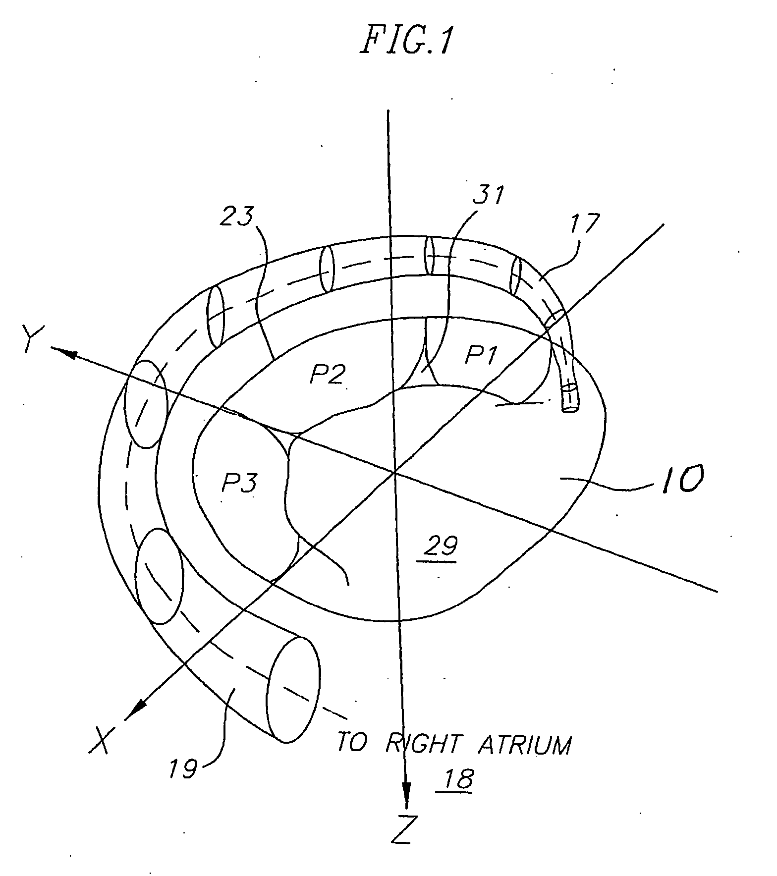 Medical implant with reinforcement mechanism