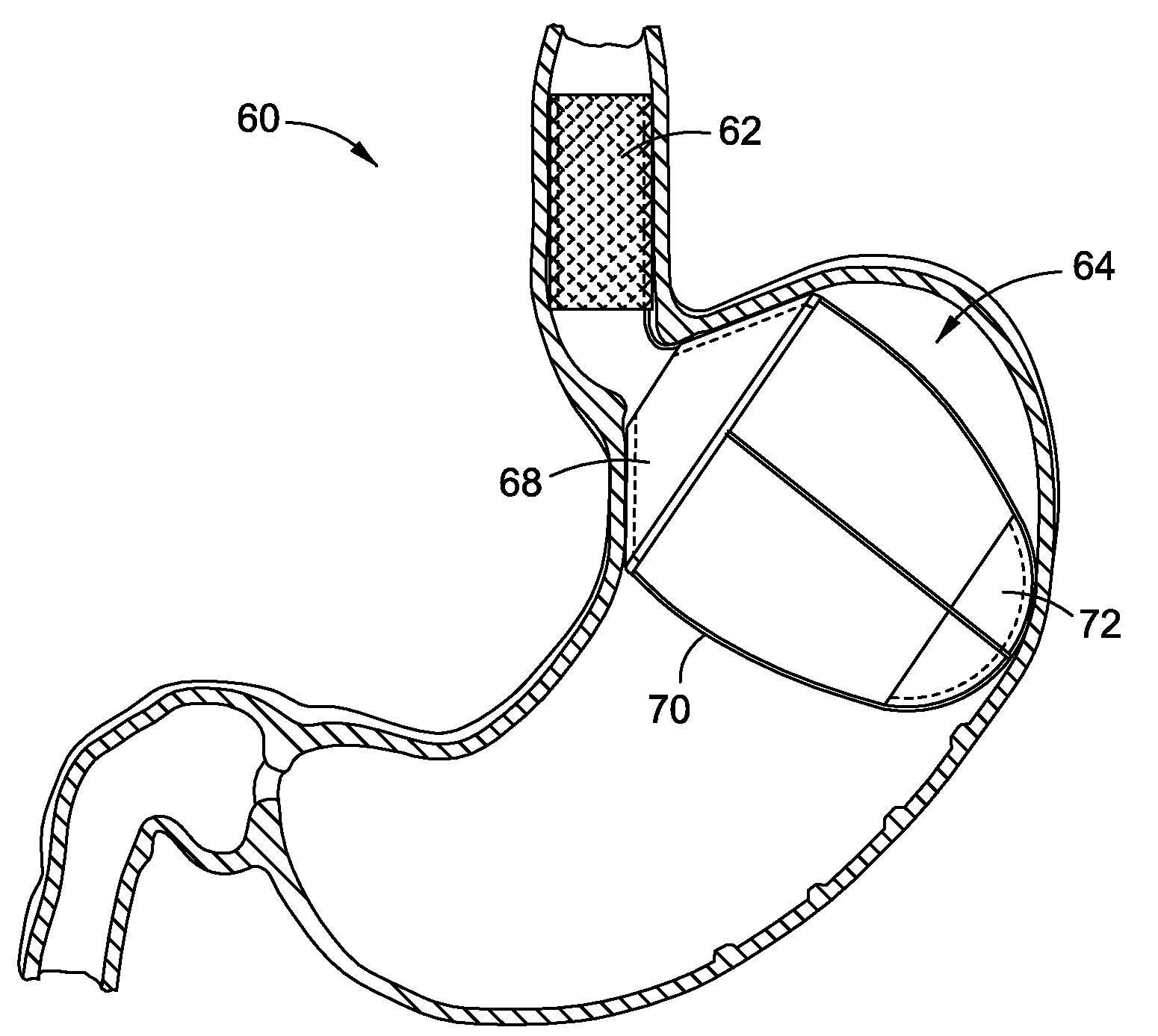 Upper stomach gastric implants