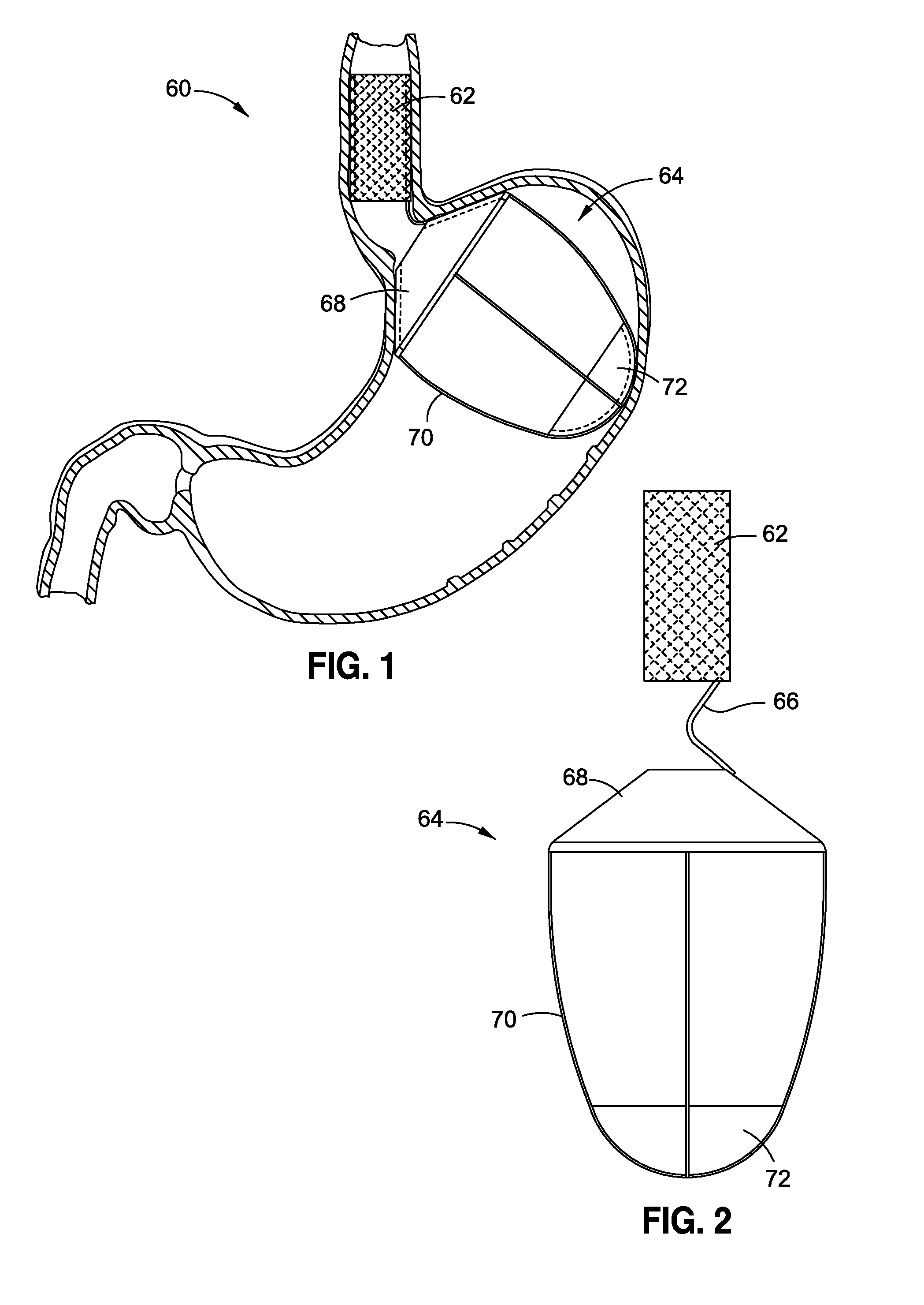 Upper stomach gastric implants