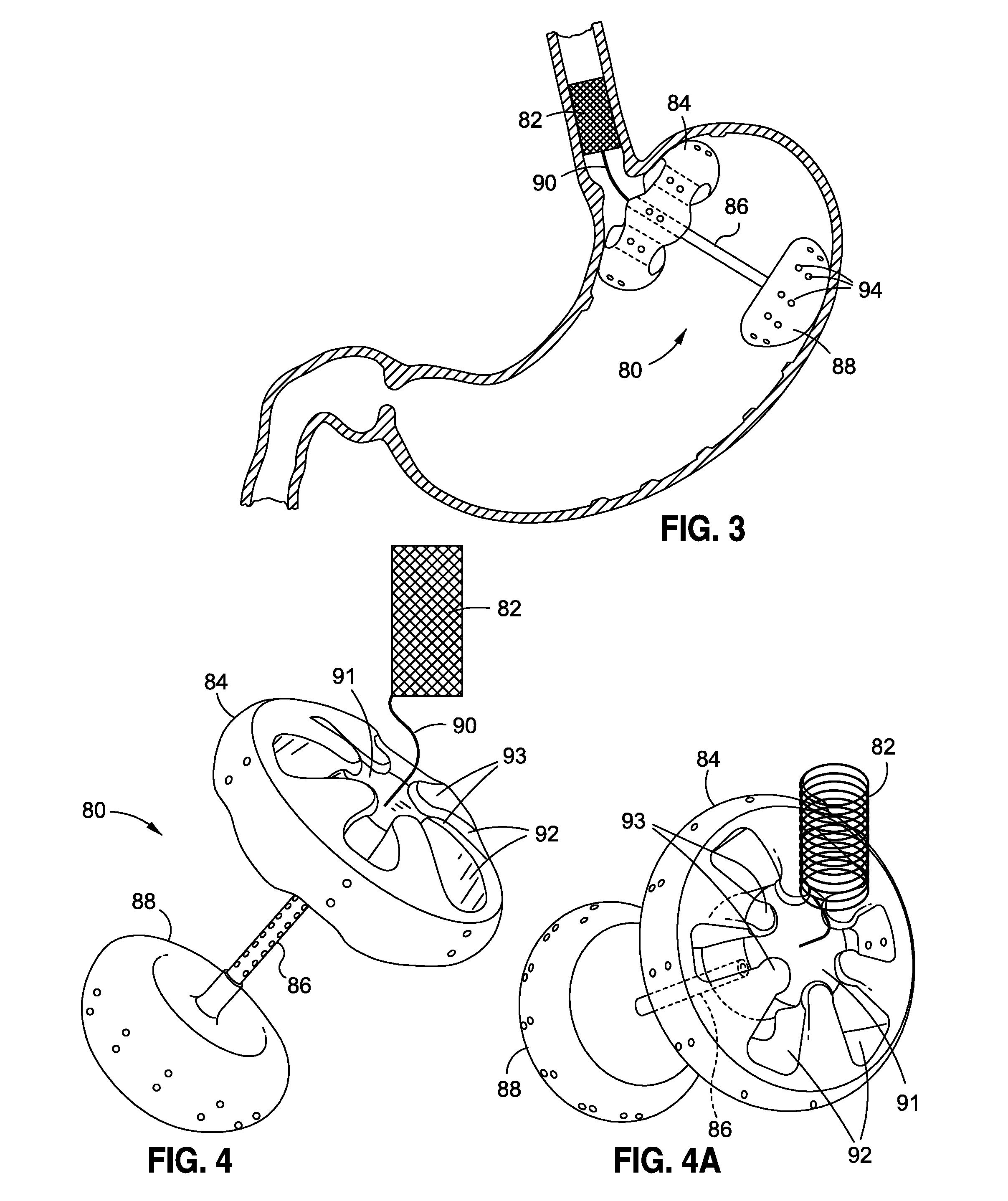 Upper stomach gastric implants