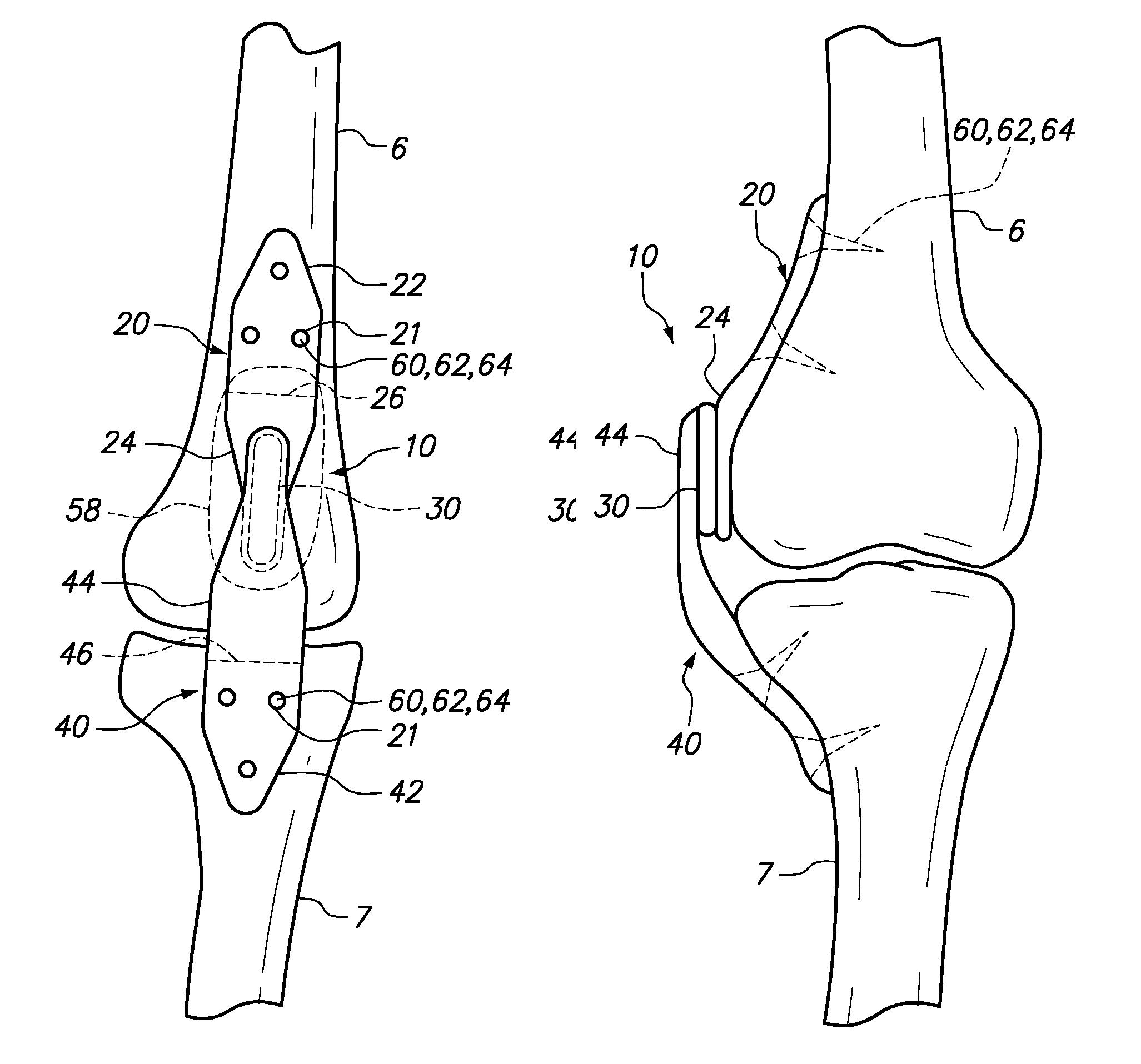 Extra-articular implantable mechanical energy absorbing assemblies having a tension member, and methods