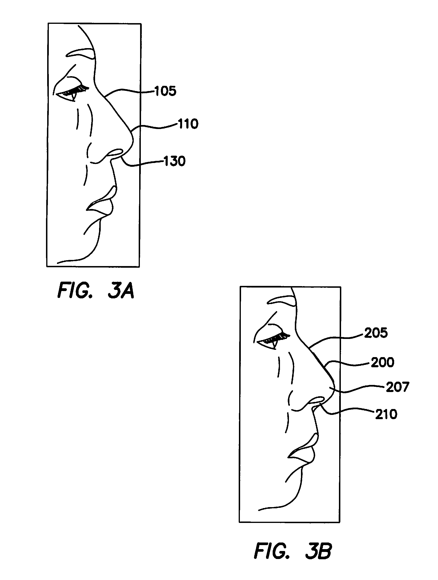 Vertical and horizontal nasal splints and methods of use