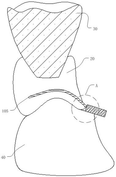 A removable partial denture and its manufacturing process