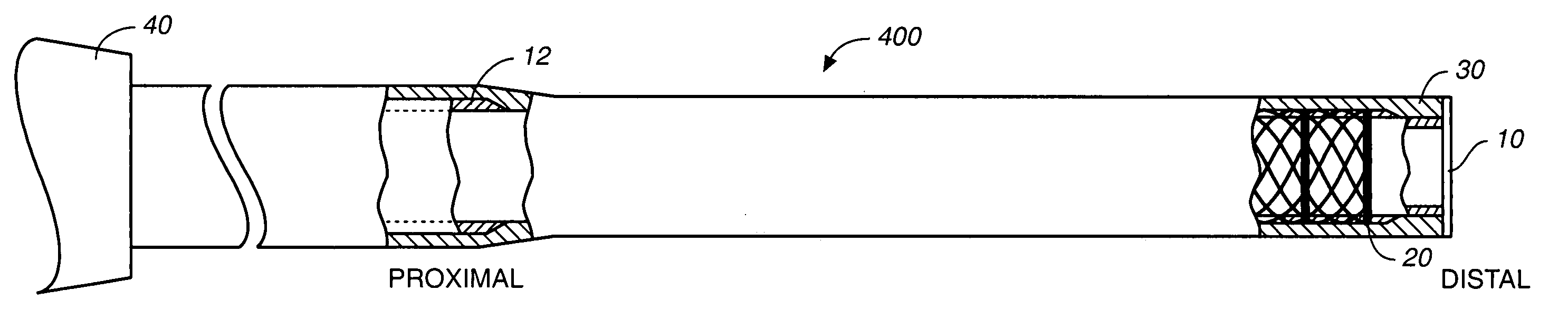 Wire braid-reinforced microcatheter