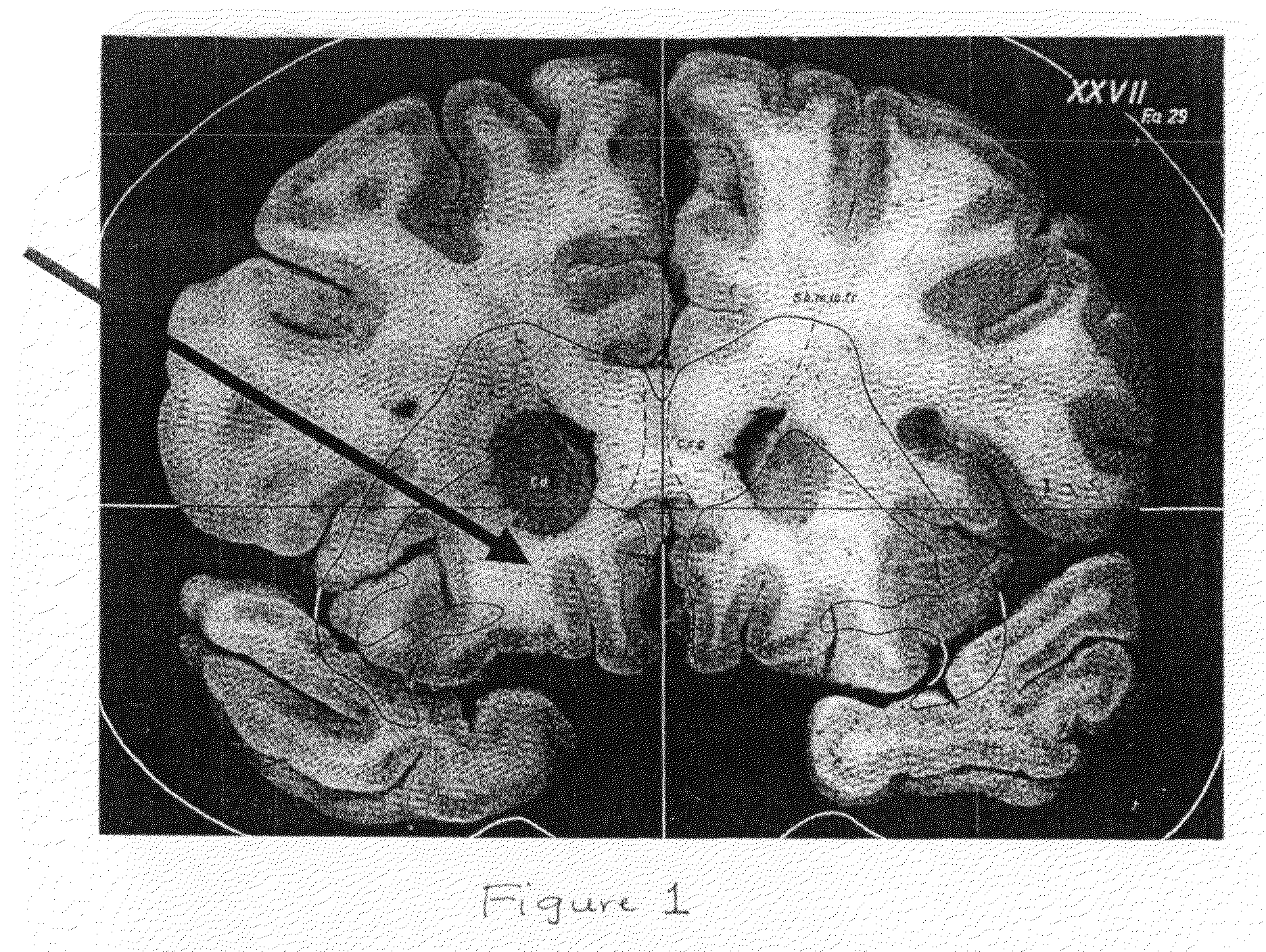 Method for treating neurological /psychiatric disorders with stimulation to the subcaudate area of the brain