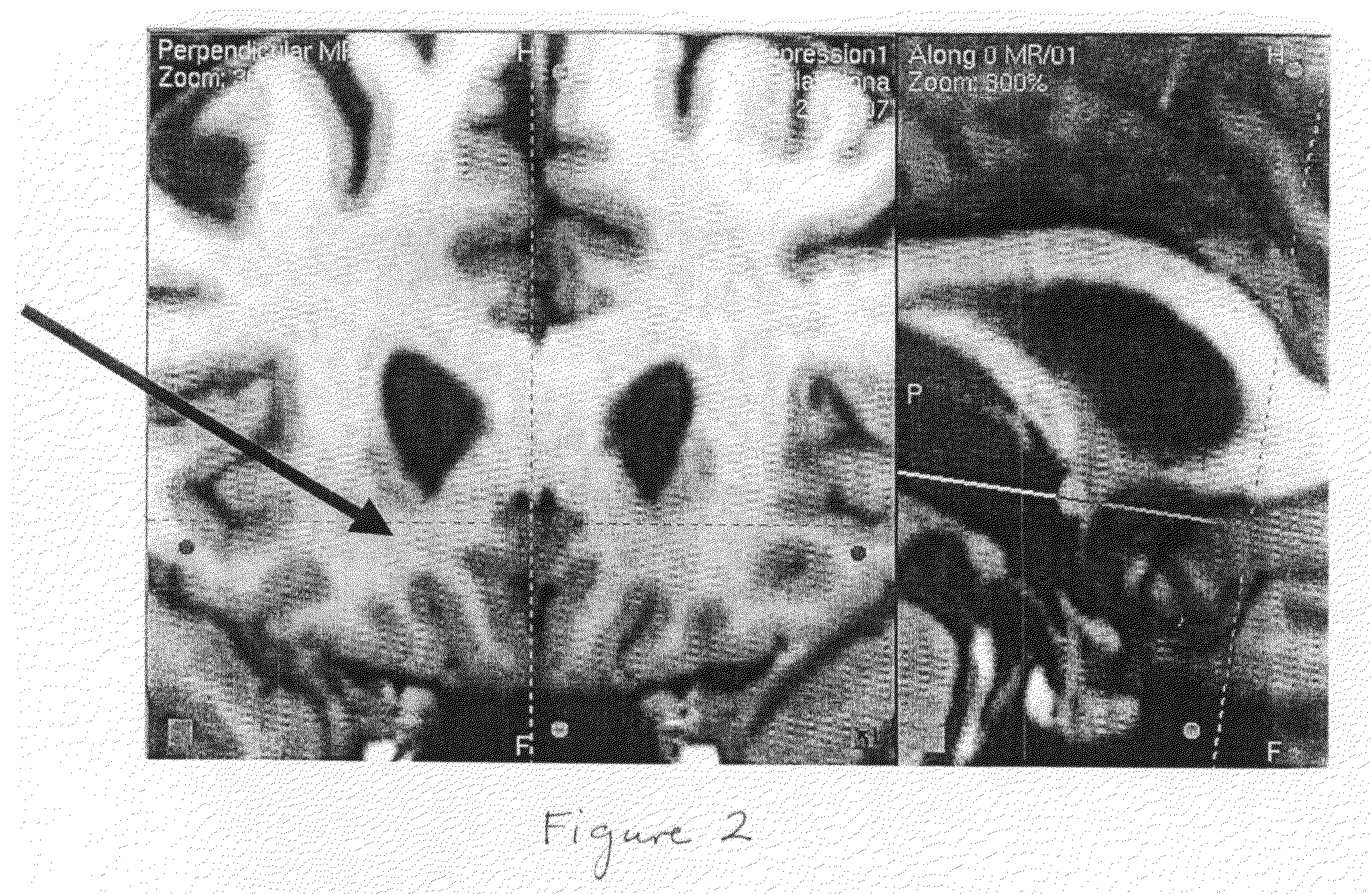 Method for treating neurological /psychiatric disorders with stimulation to the subcaudate area of the brain