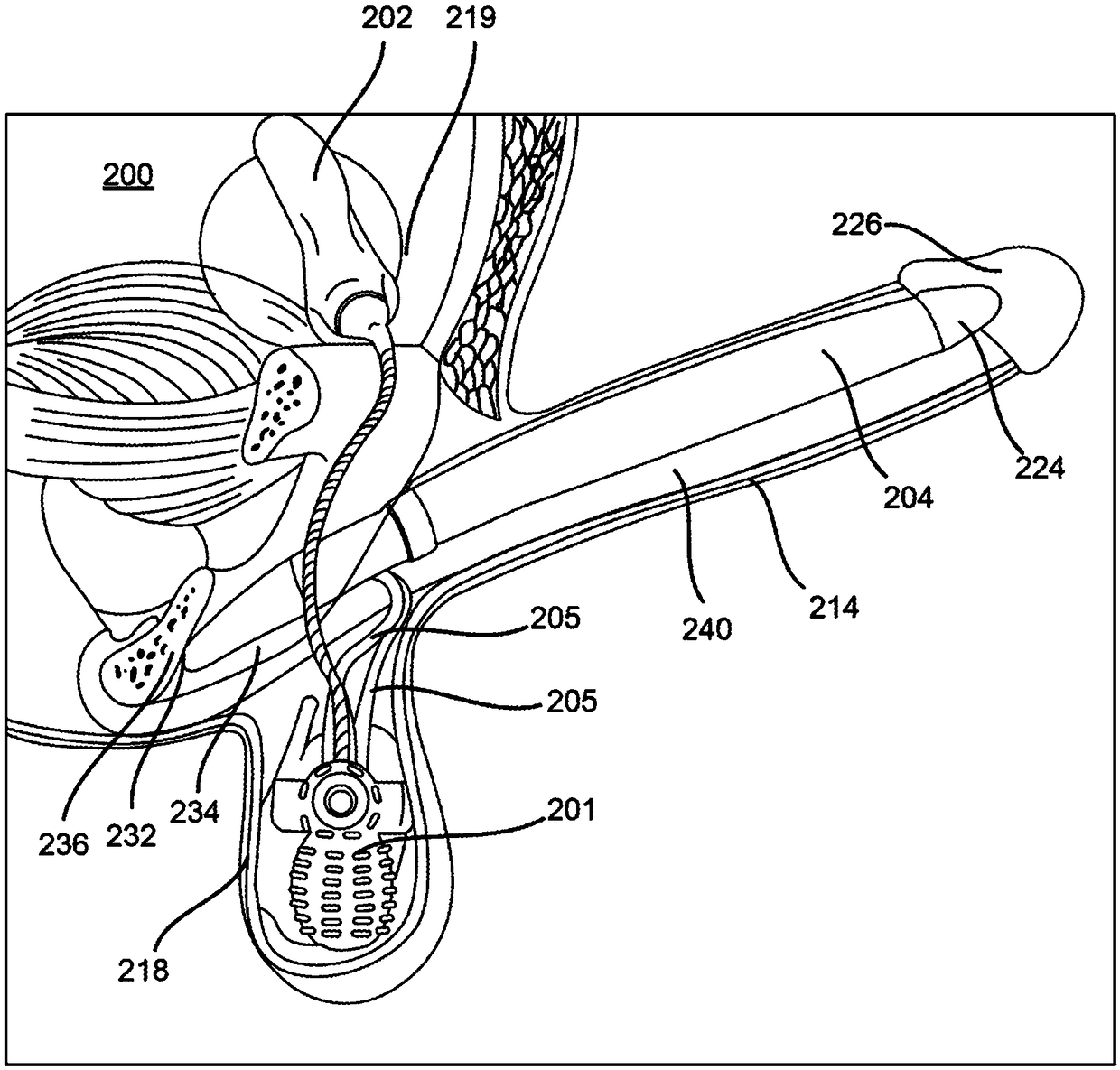 Inflatable penile prosthesis with reversible flow pump assembly