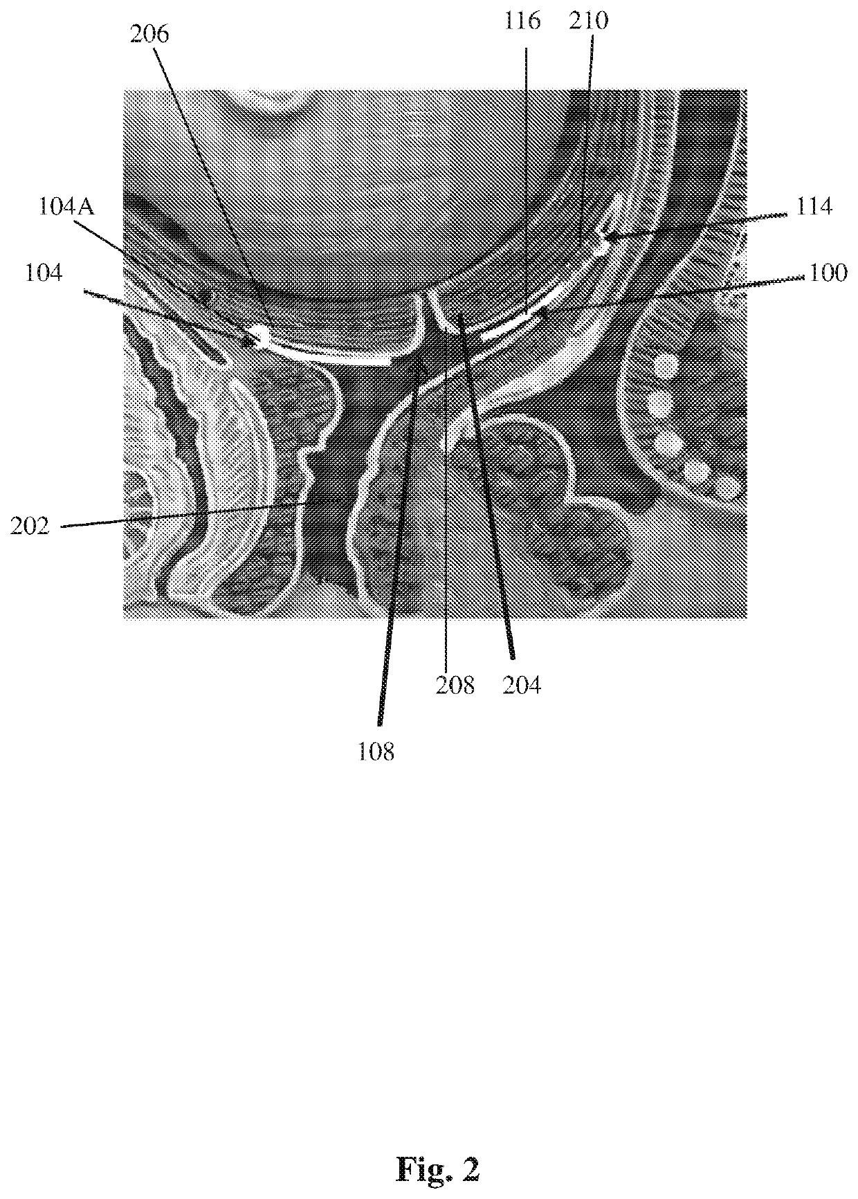 Electrical inhibition (EI) uterine pacemaker for controlling preterm uterine contractions and preterm birth