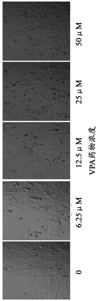 Application of sodium valproate in preparation of drug for treating human coronavirus infected pneumonia