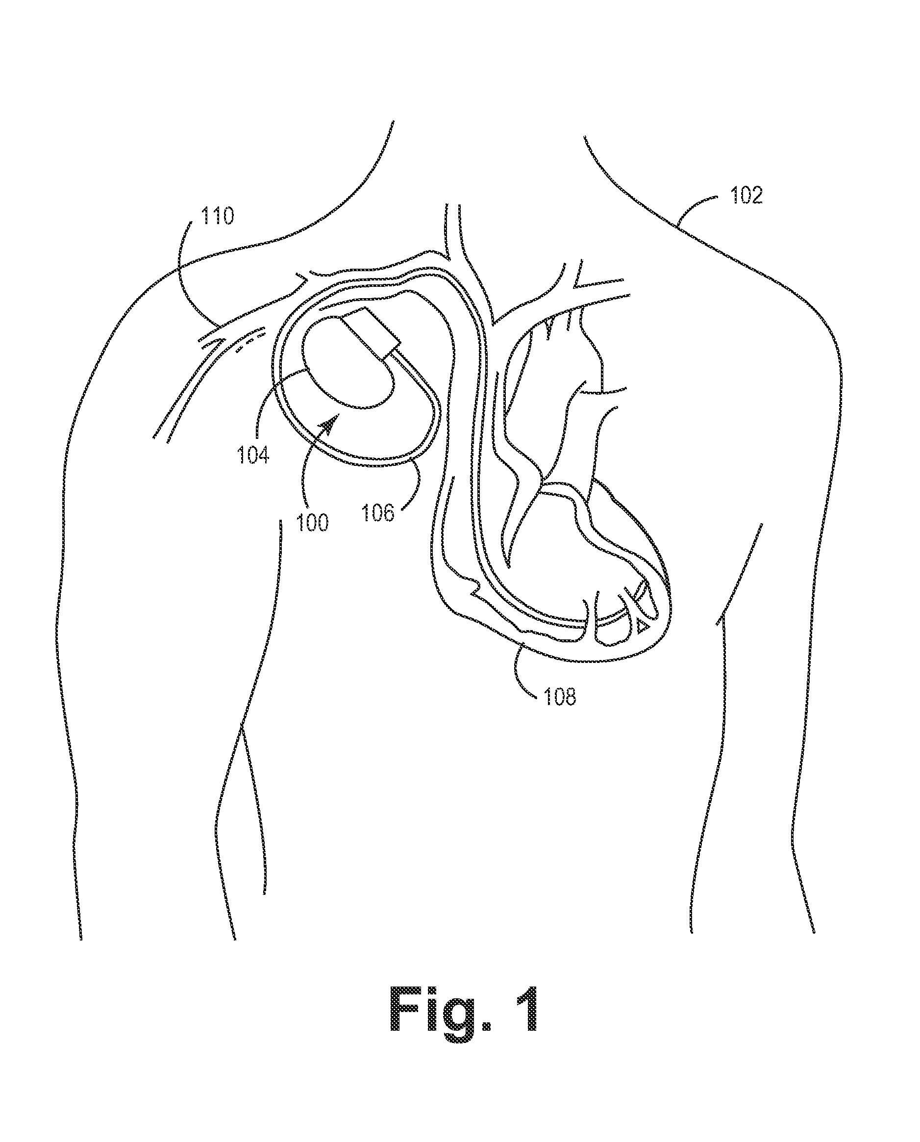 Integrated planar flyback transformer