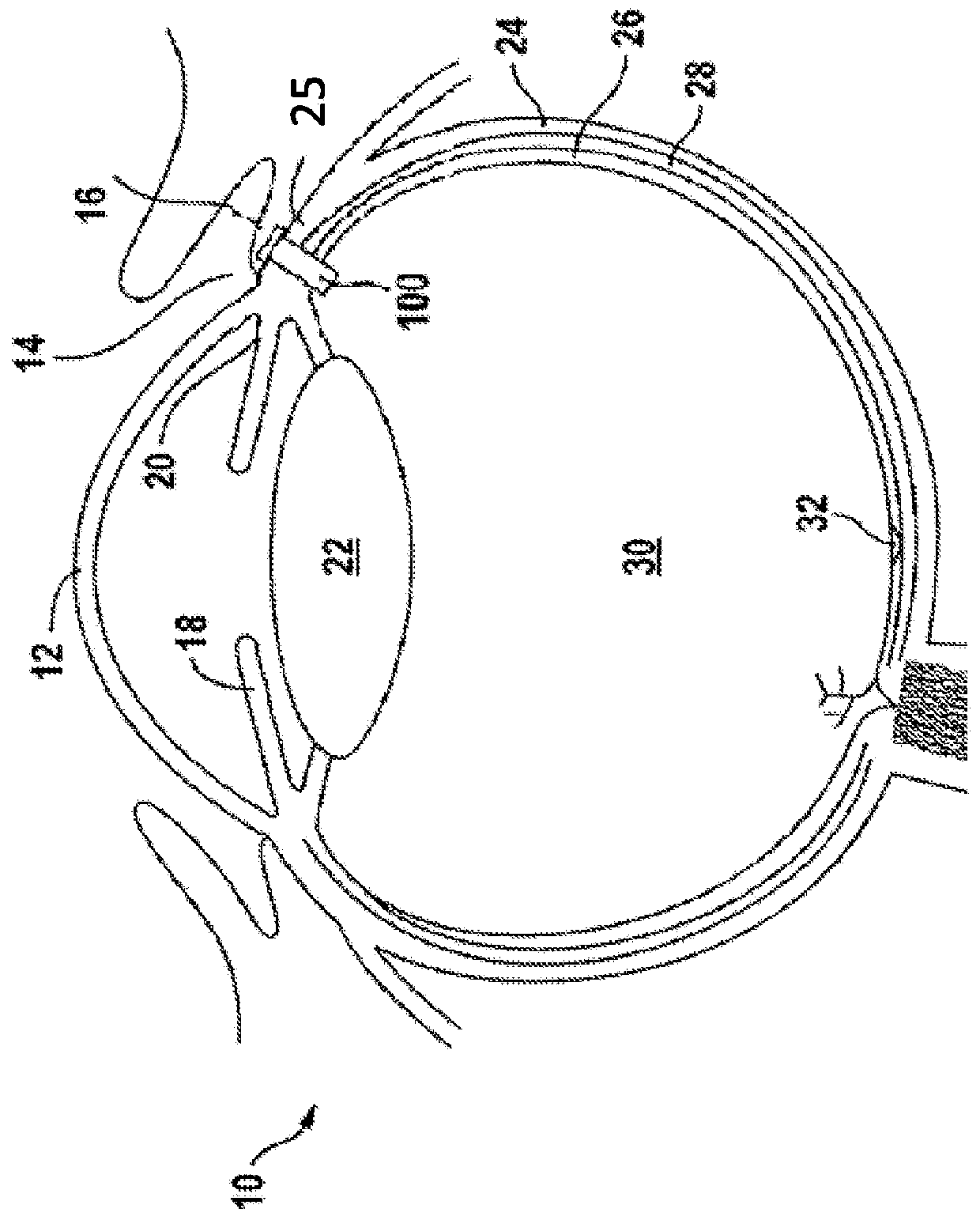 Ophthalmic implants for delivery of therapeutic substances