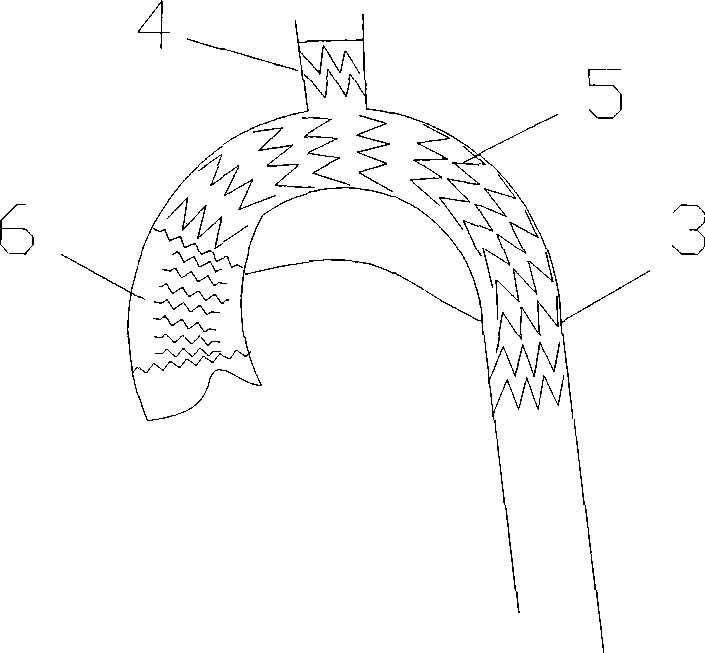 Adjustable single-branch artificial aortic arch implant