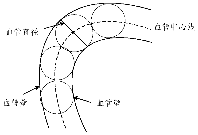 Method for identifying local vascular stenosis degree in DSA coronary artery image