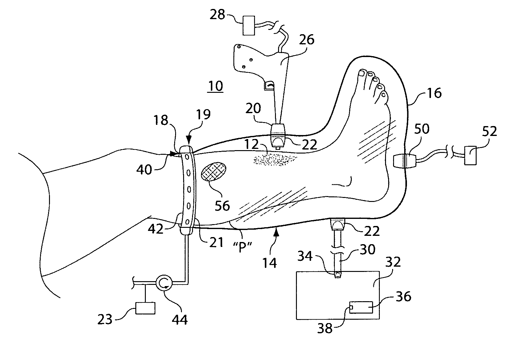 Wound irrigation containment arrangement