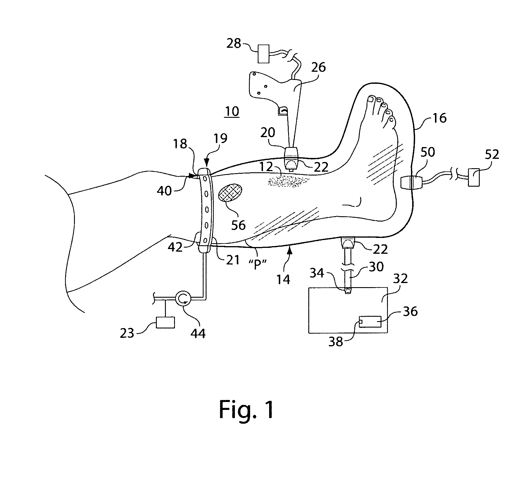 Wound irrigation containment arrangement