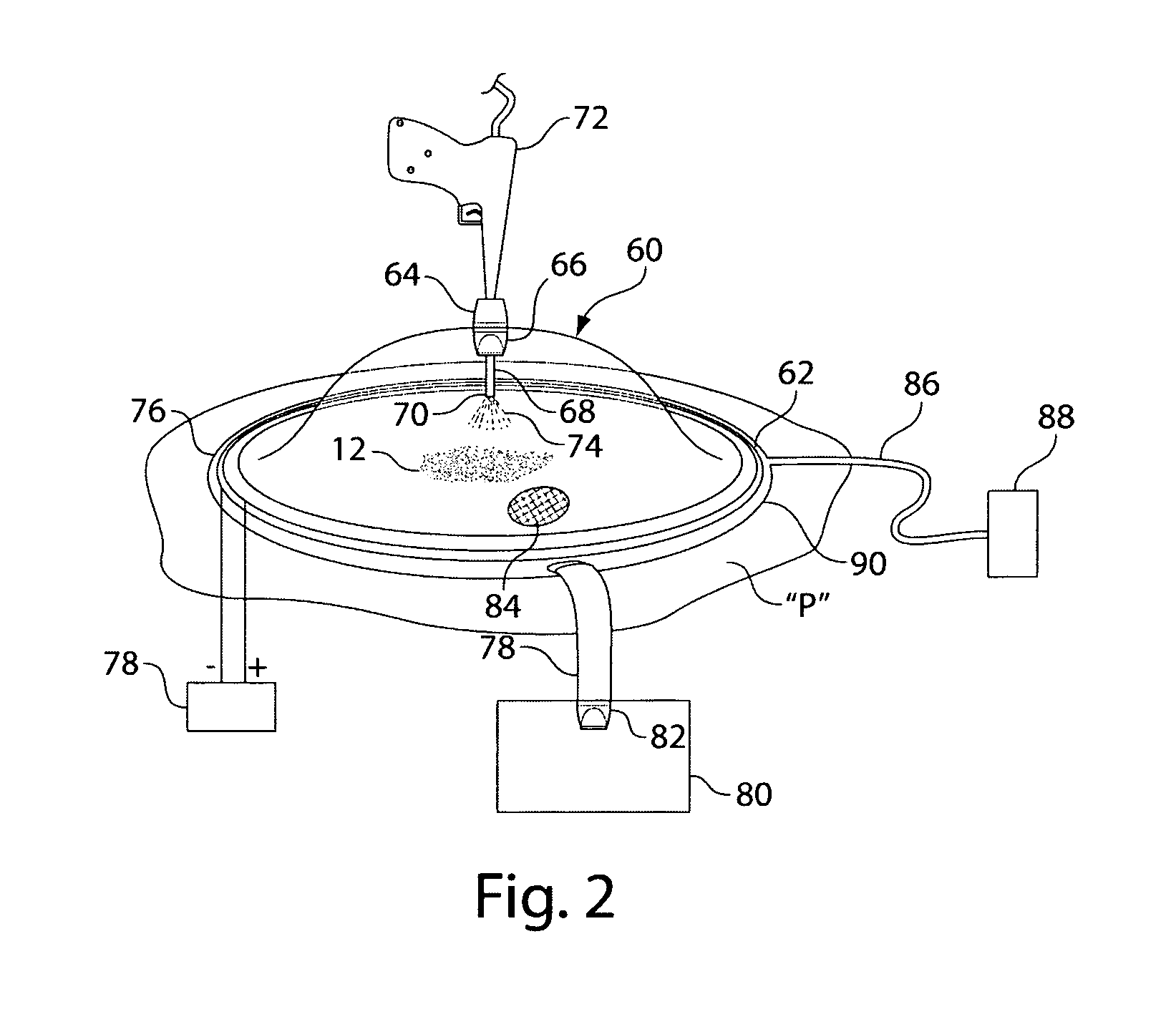 Wound irrigation containment arrangement