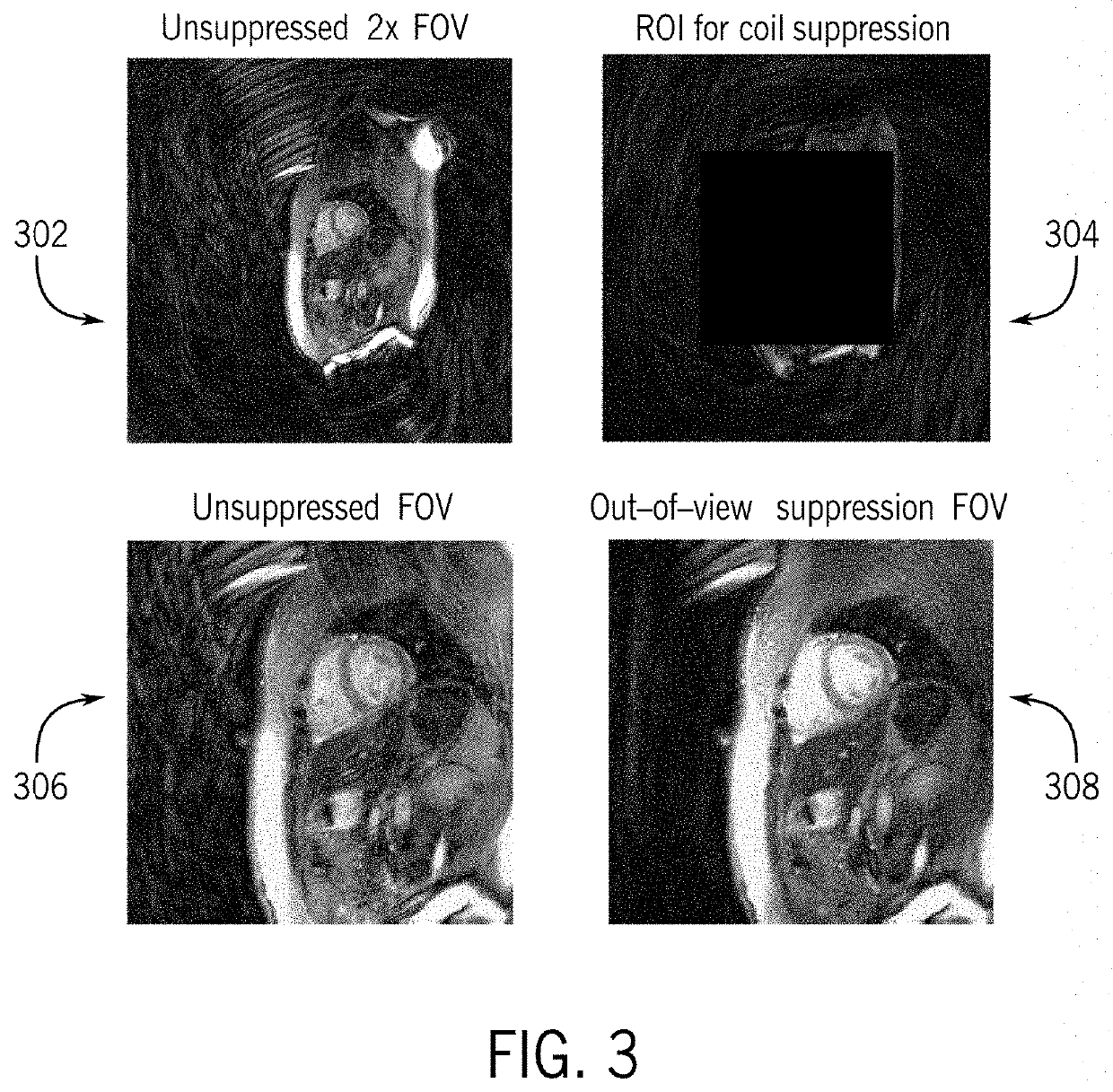 System and method for out-of-view artifact suppression for magnetic resonance fingerprinting