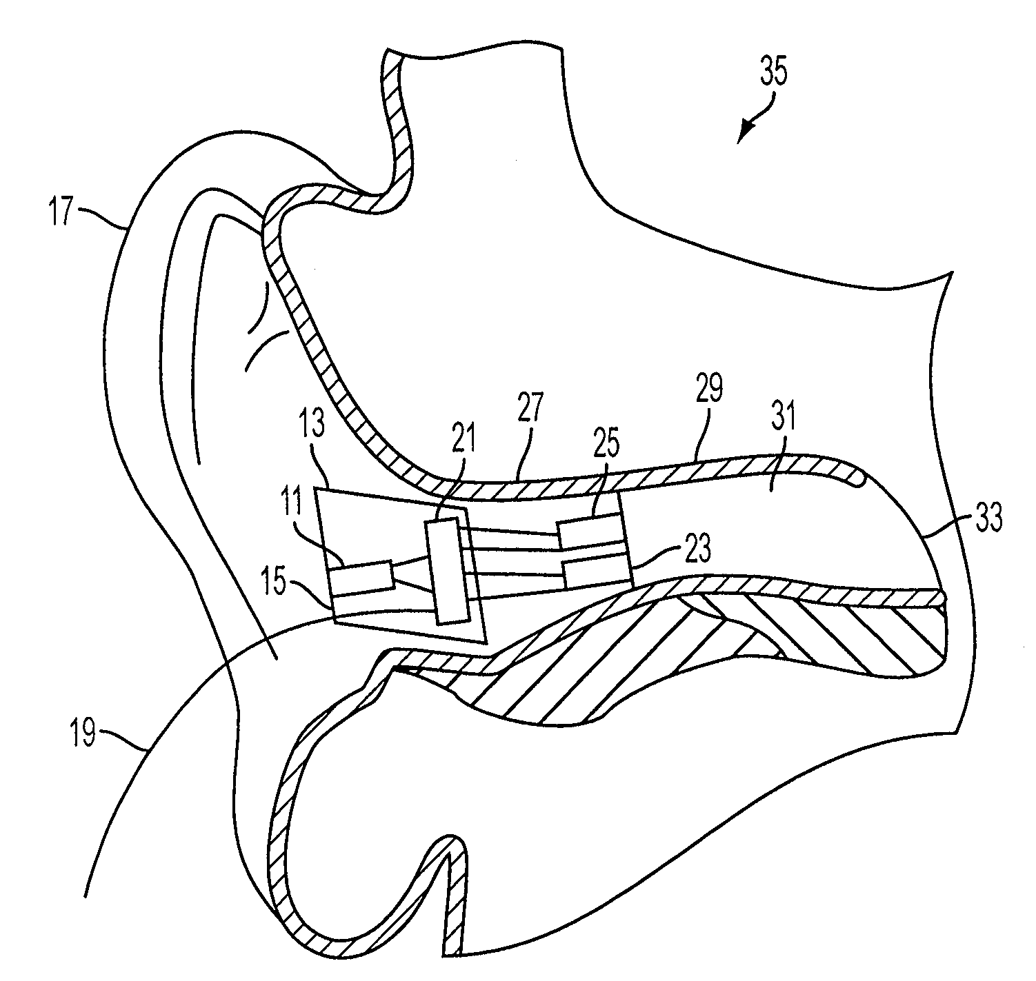 Earhealth monitoring system and method ii