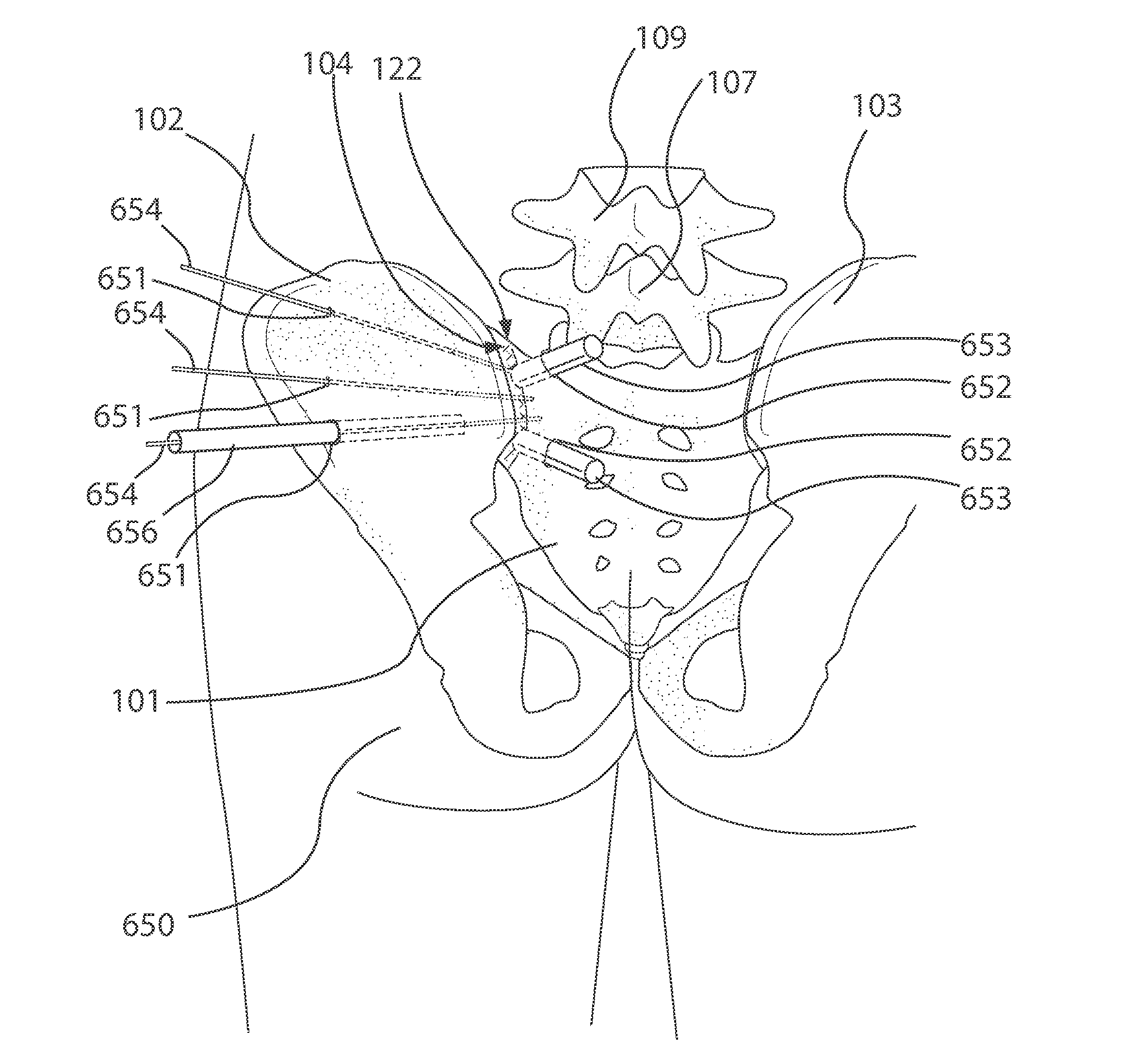 Minimally invasive approaches, methods and apparatuses to accomplish sacroiliac fusion