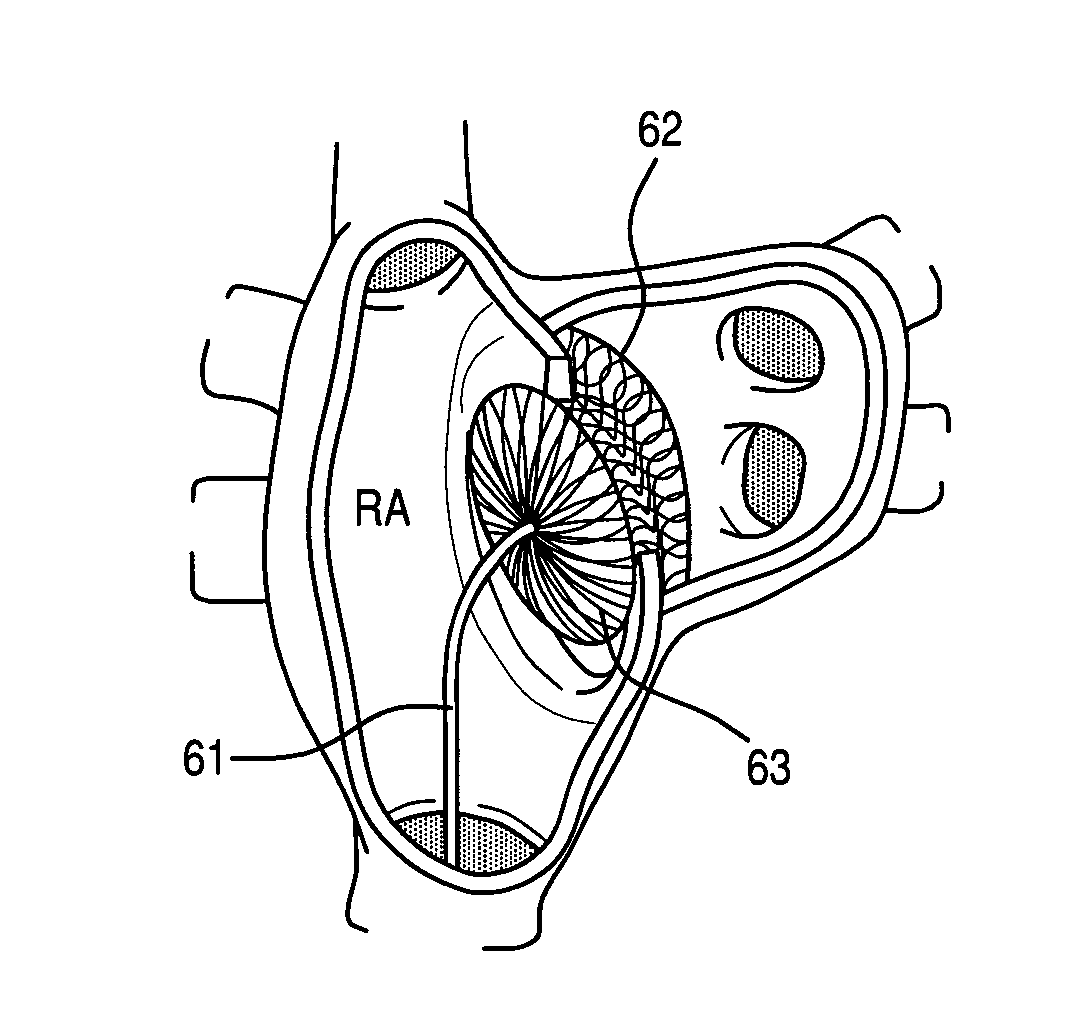 Atrial Septal Occluder Device and Method