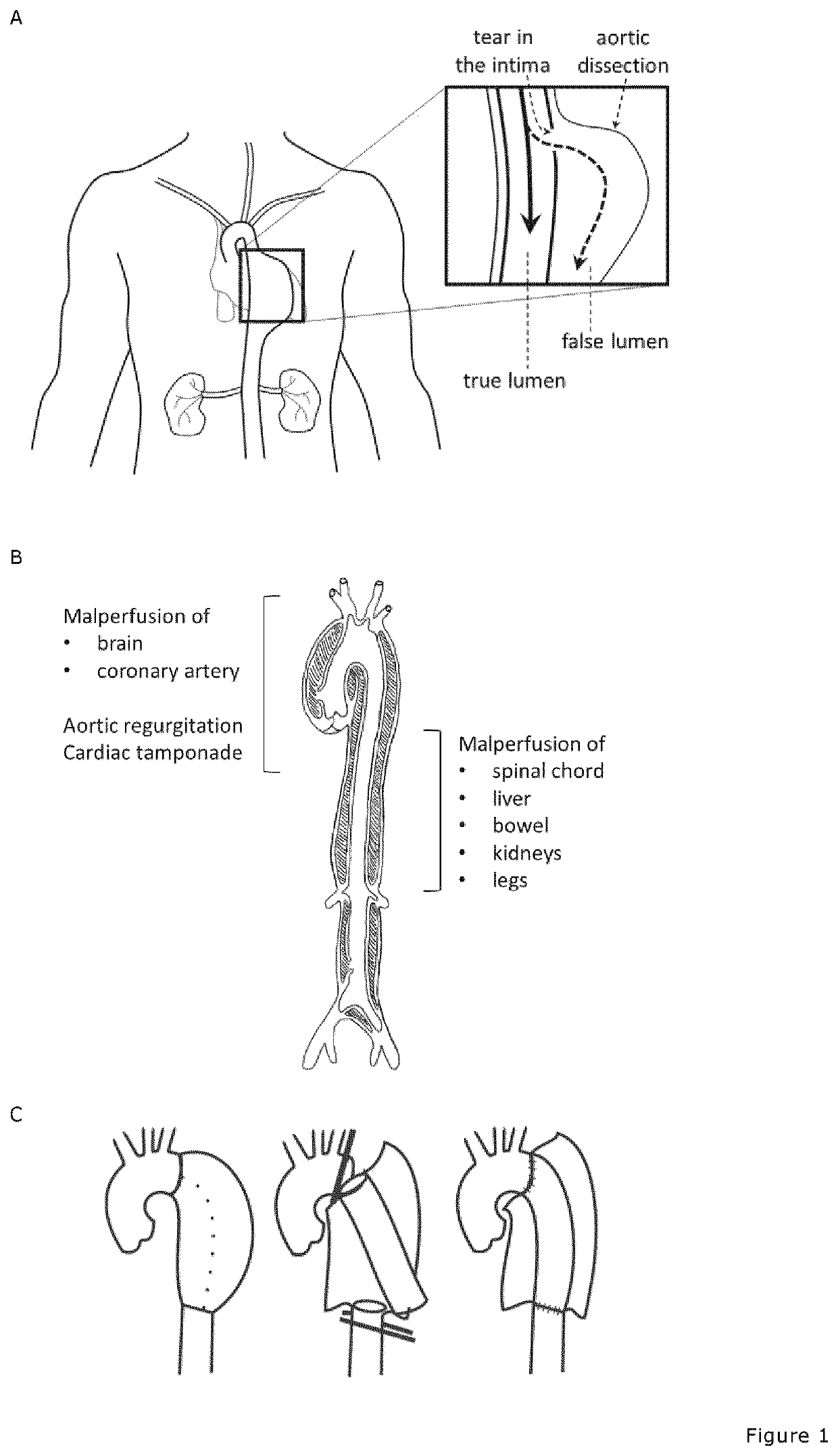 Treatment of patients under antiplatelet medication experiencing acute bleeding complications during/after surgery