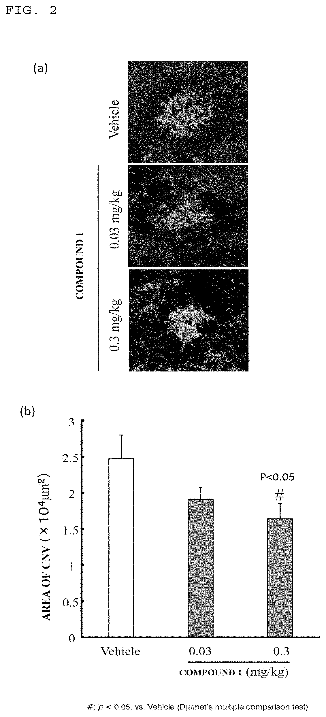 Medicine for preventing or treating ophthalmic disease associated with enhanced intraocular neovascularization and/or intraocular vascular permeability