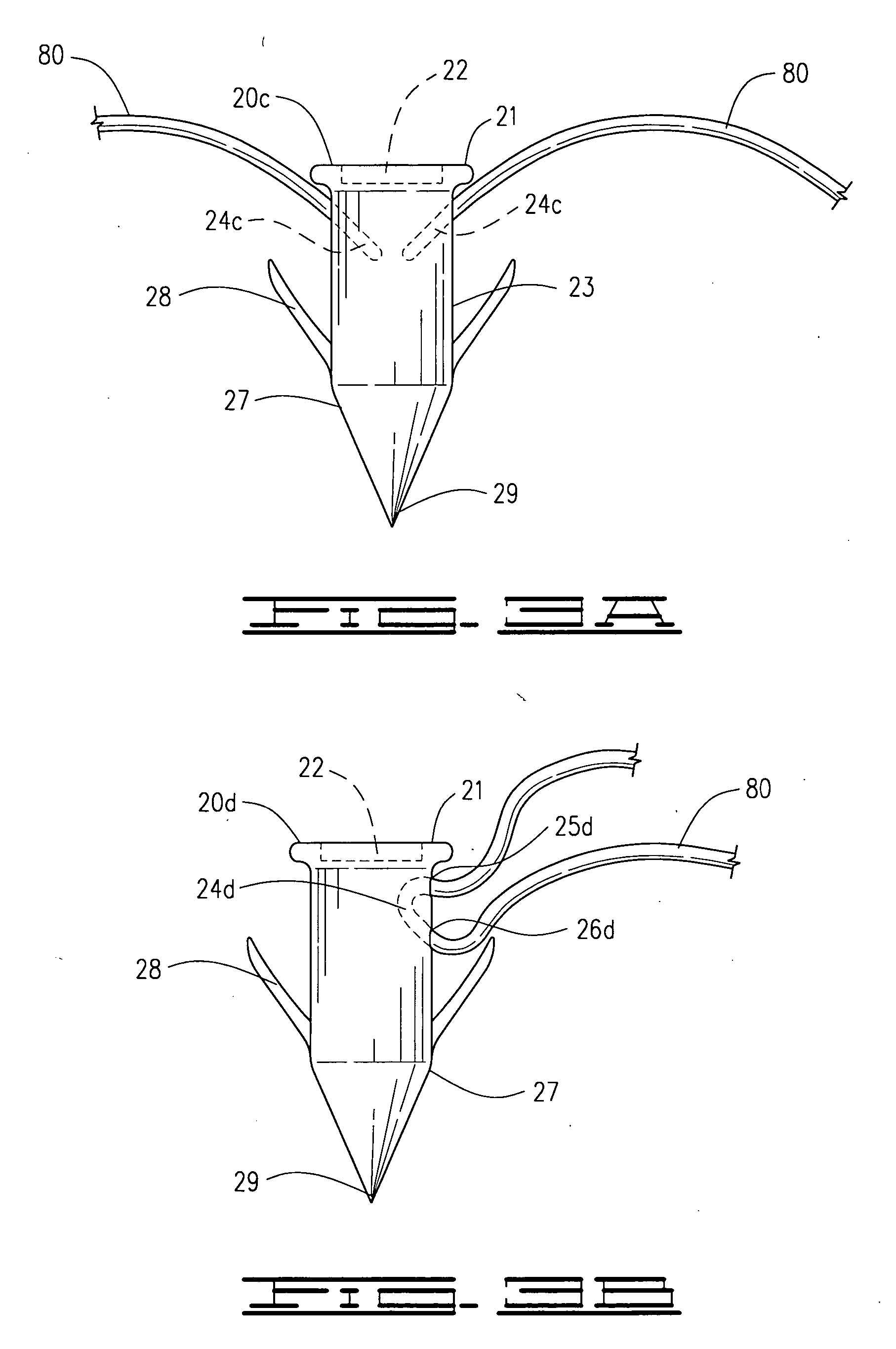 Surgical suture staple and attachment device for securing a soft tissue to a bone