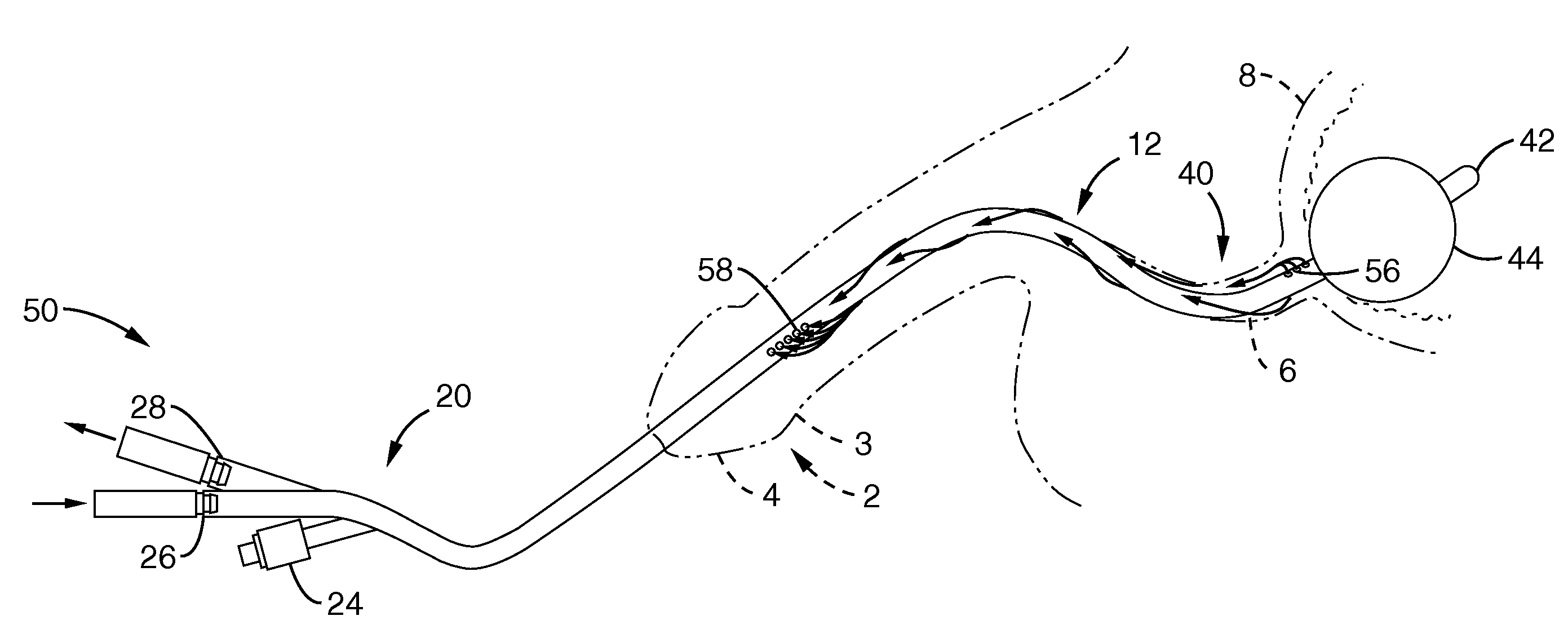 System and method for urinary tract cell collection, diagnosis, and chemotherapy