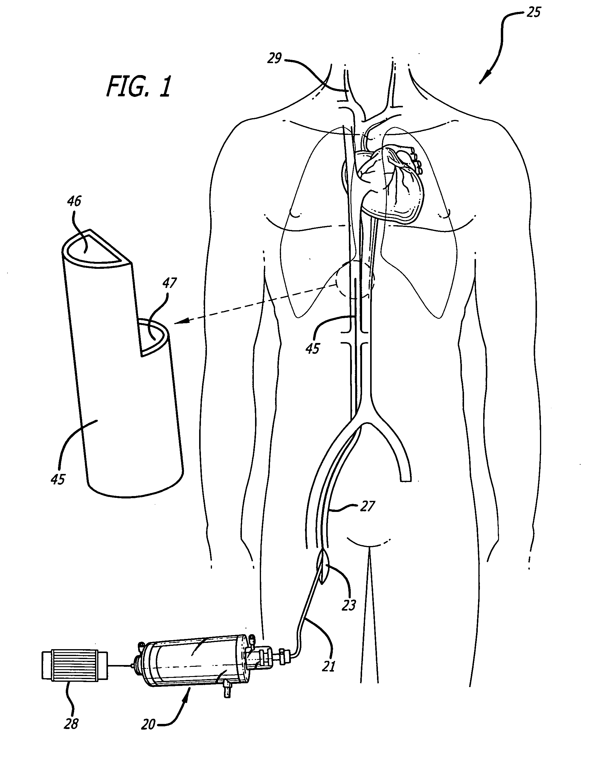 Paracorporeal respiratory assist lung