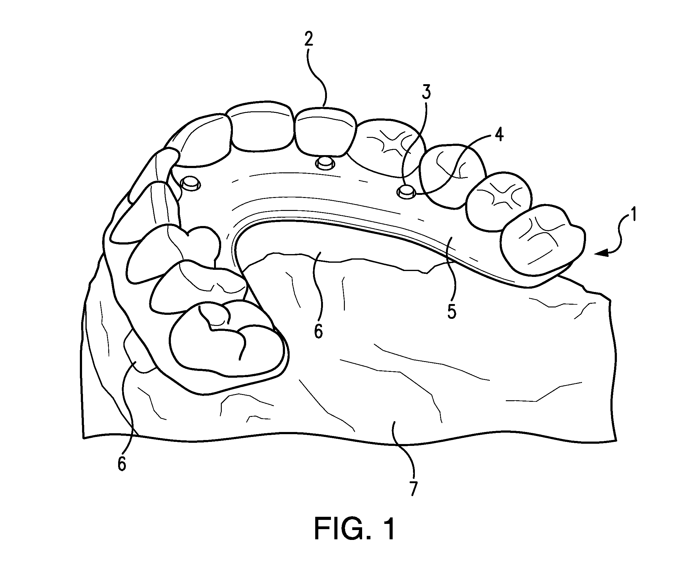 Apparatuses and methods for making a final hybrid prosthesis to be attached to dental implants