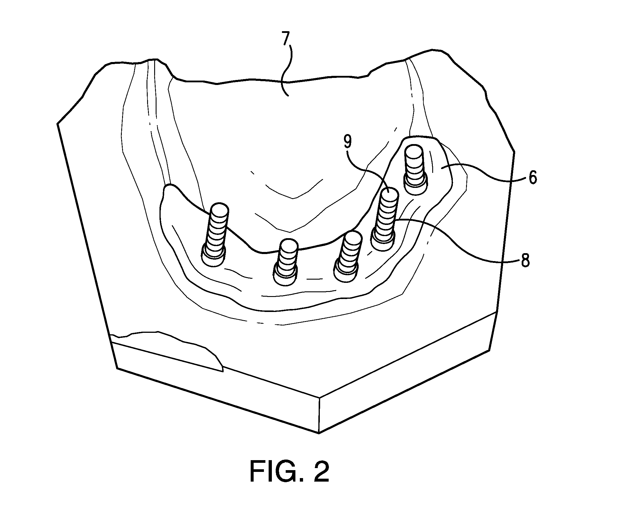 Apparatuses and methods for making a final hybrid prosthesis to be attached to dental implants