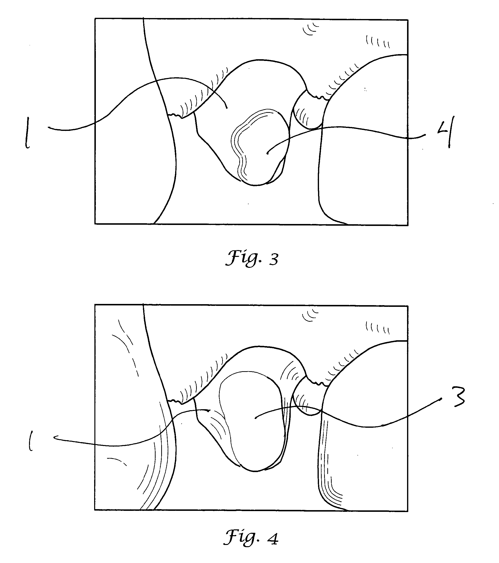 Method of preparing dentition for the taking of a dental impression