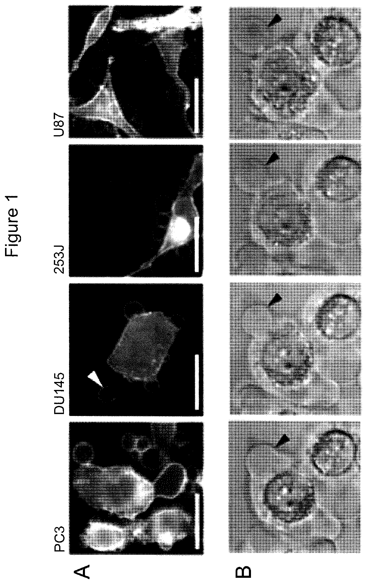 Palmitoyl Protein Biomarkers in Purified Extracellular Vesicles for Early Identification of Clinically Significant Prostate Cancer