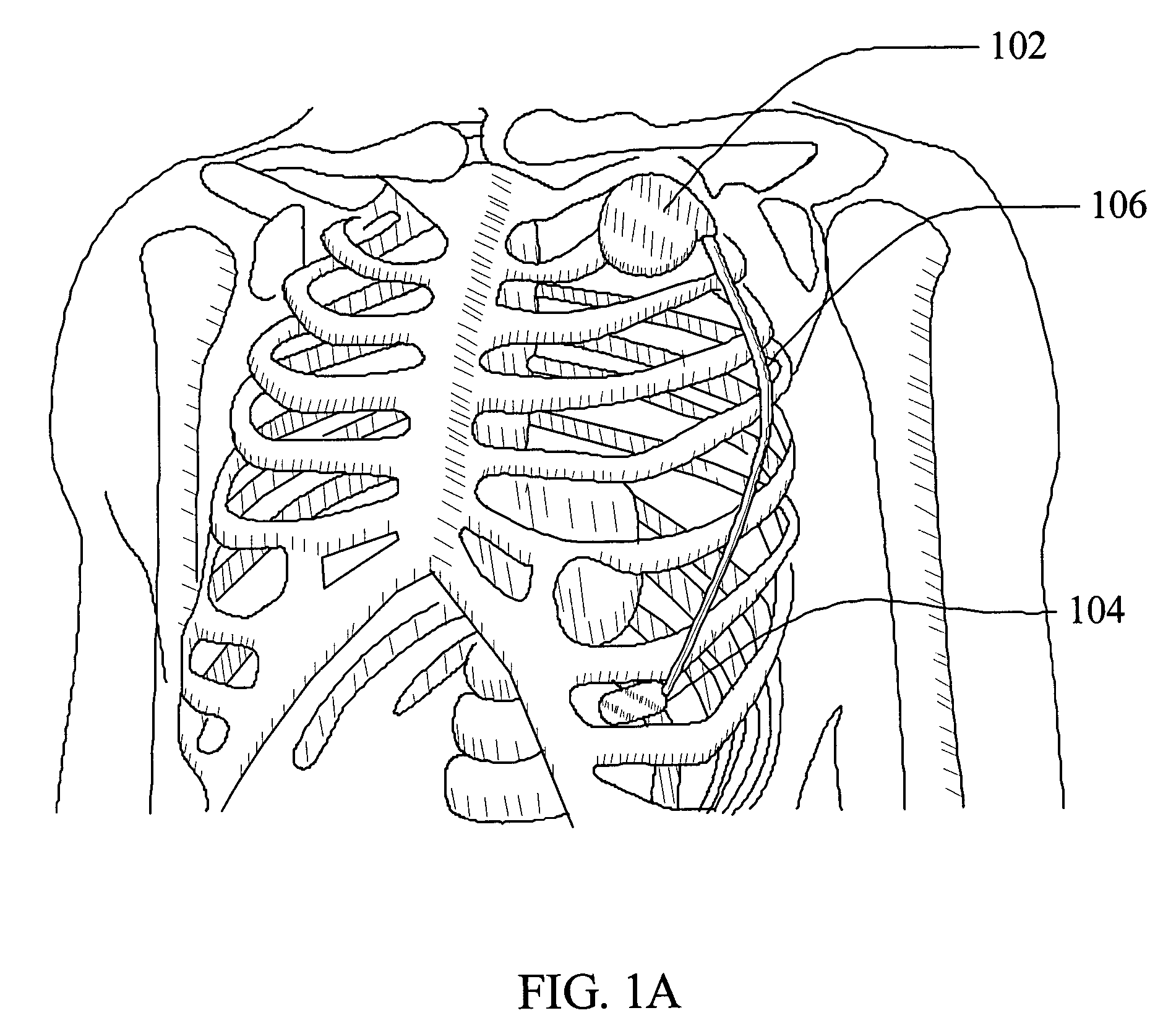 Subcutaneous electrode and lead with temporary pharmacological agents