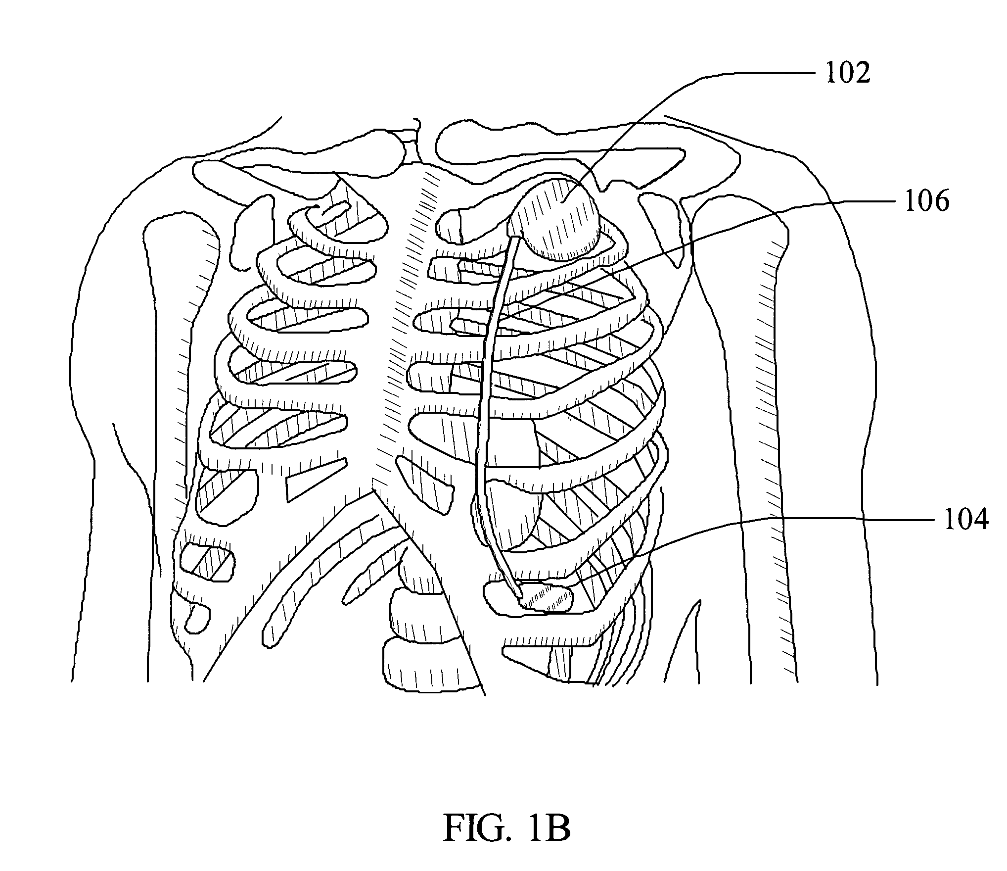 Subcutaneous electrode and lead with temporary pharmacological agents