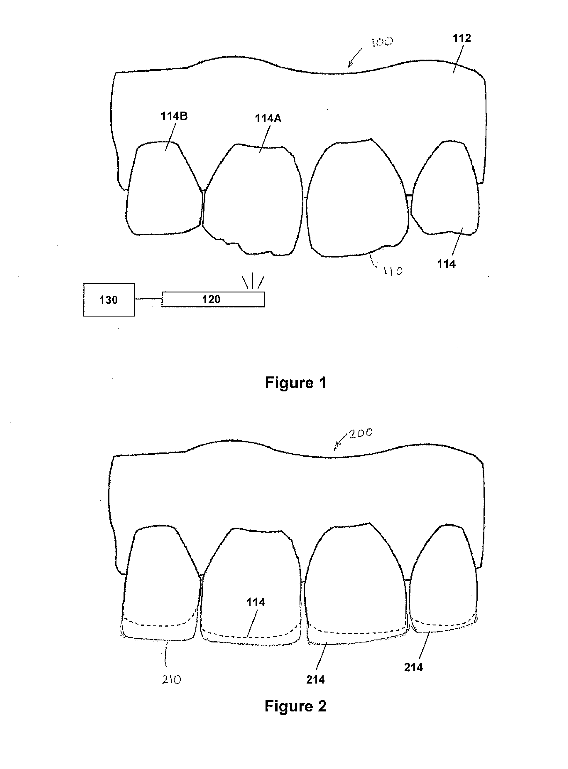 Method for dental restoration and related kit