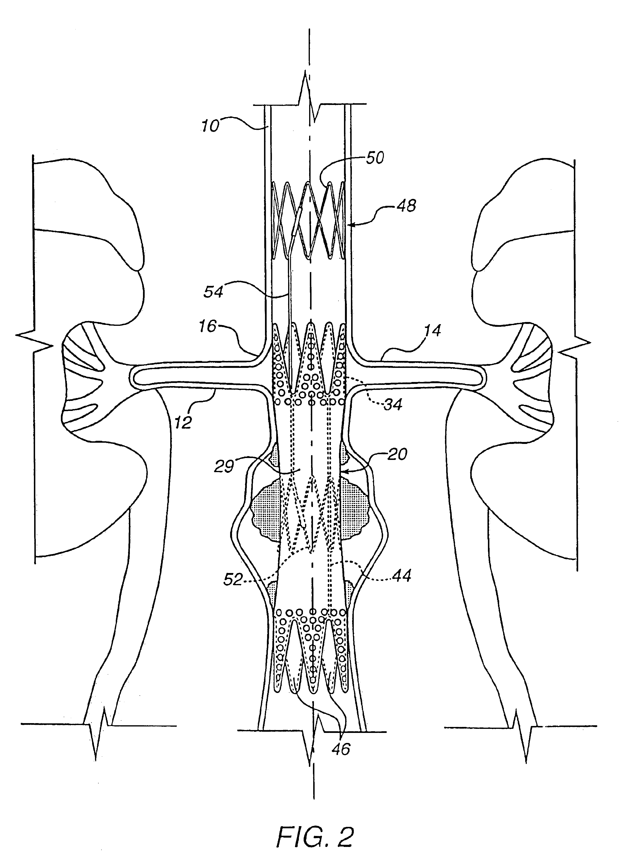 Method for engrafting a blood vessel