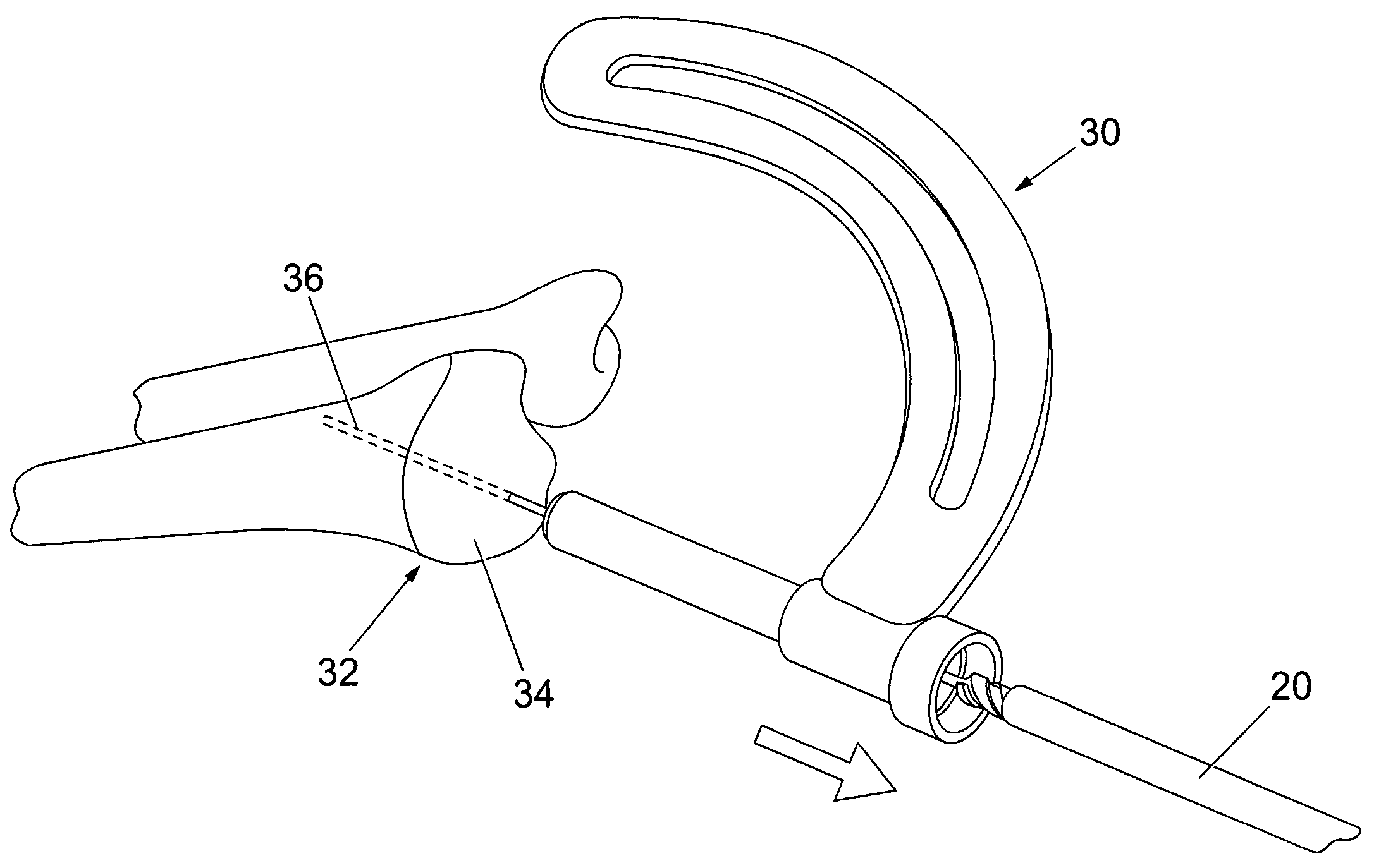 Method of bone surgery