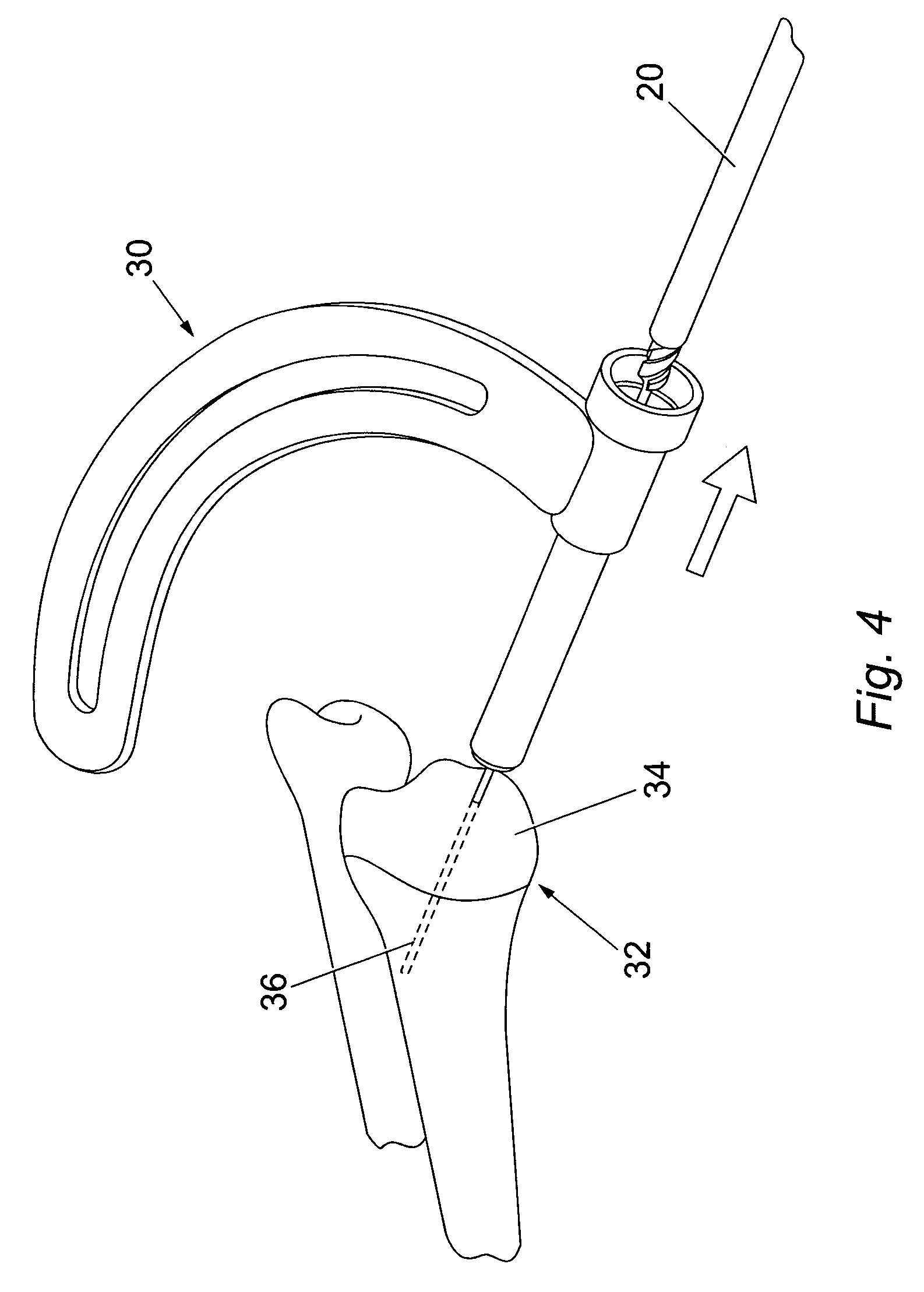 Method of bone surgery