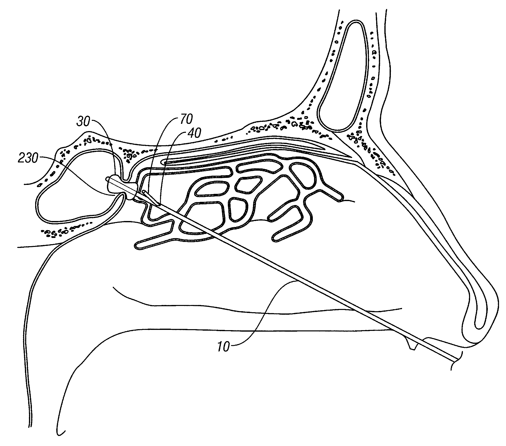 Multi-lumen catheter and endoscopic method