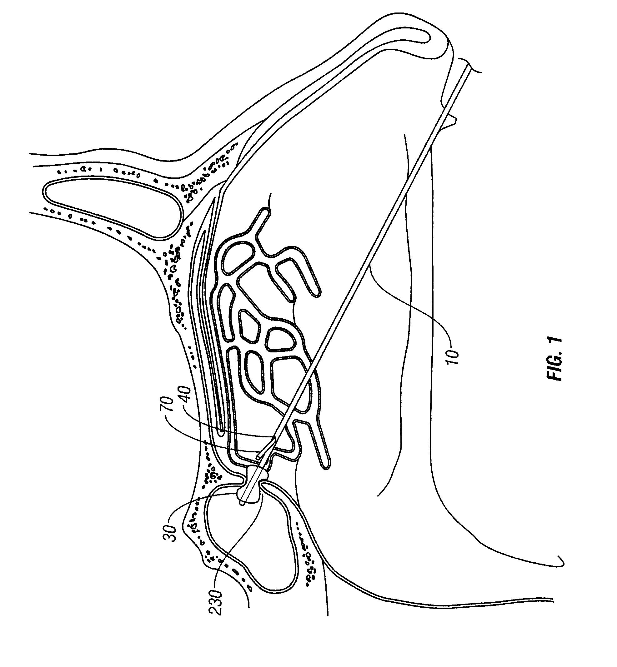 Multi-lumen catheter and endoscopic method